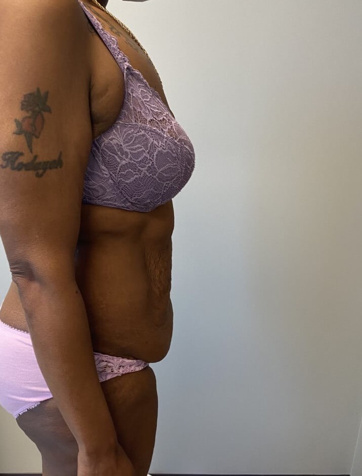 Tummy Tuck Surgery Before