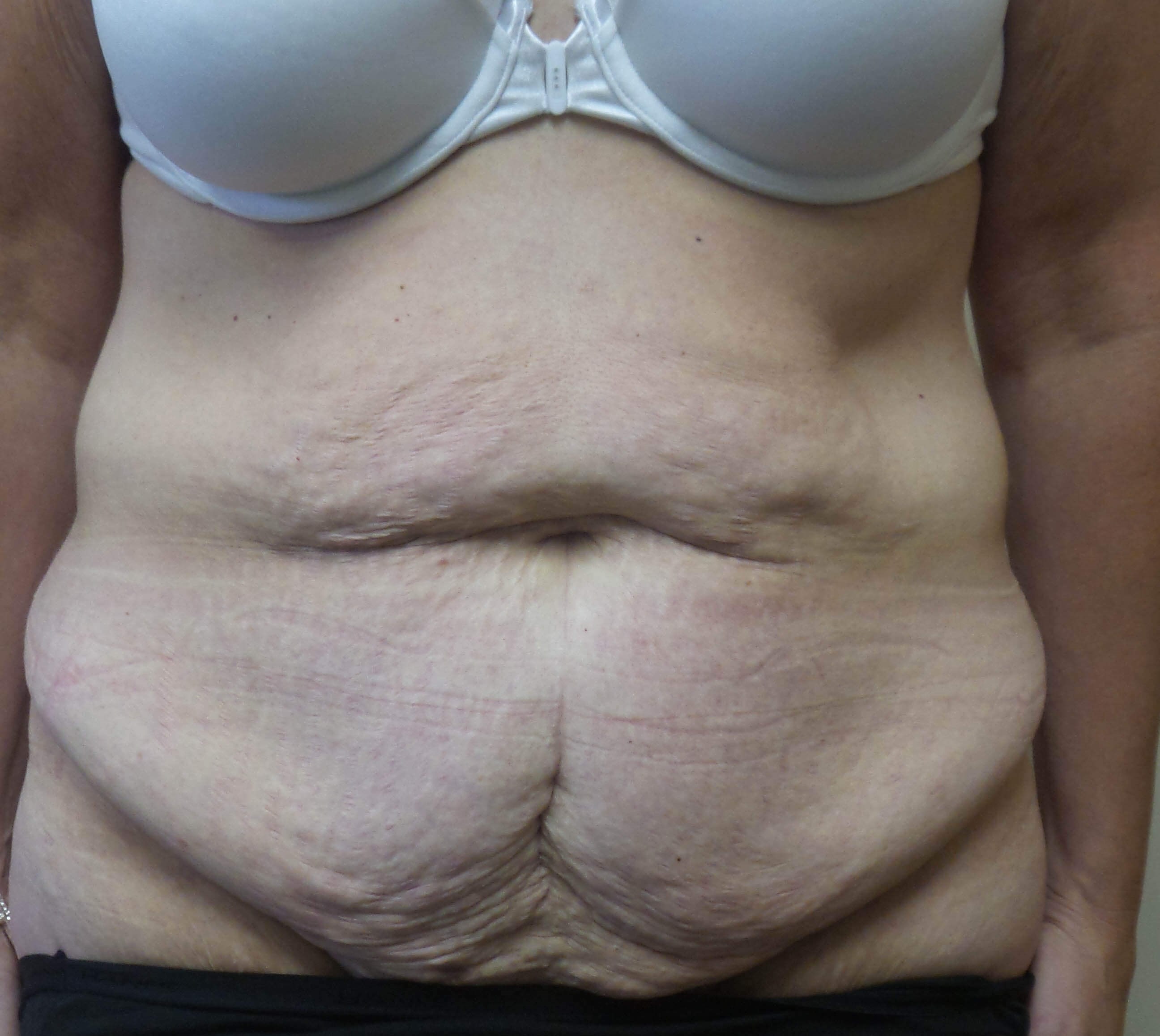 Abdominoplasty Surgery Before