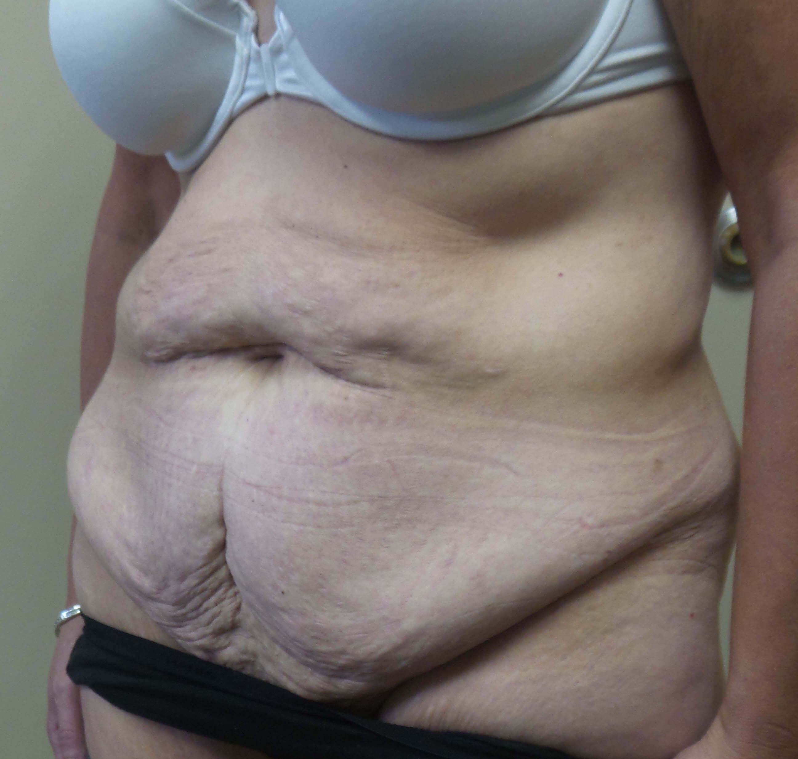 Abdominoplasty Surgery Before