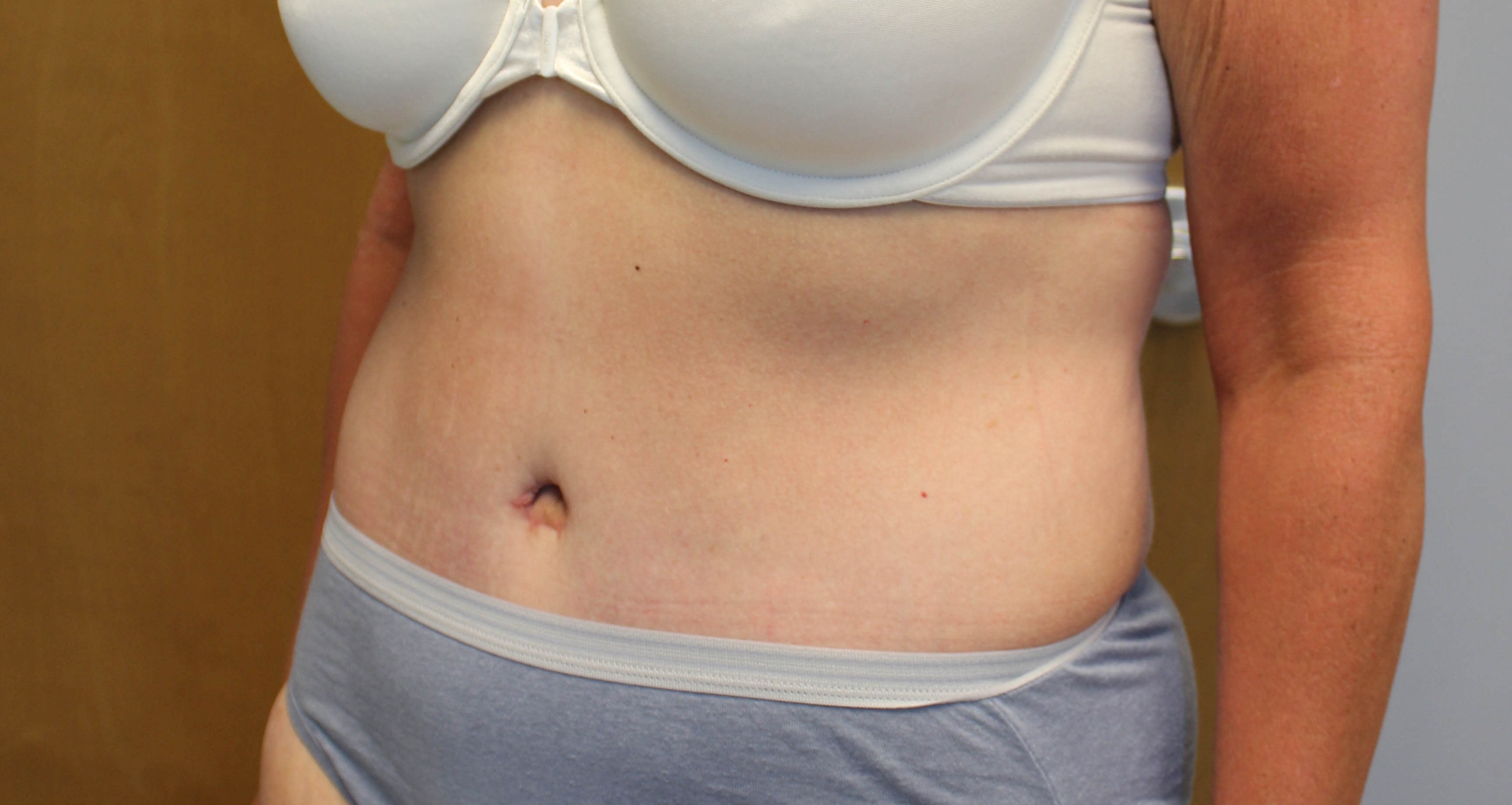 Abdominoplasty Surgery After