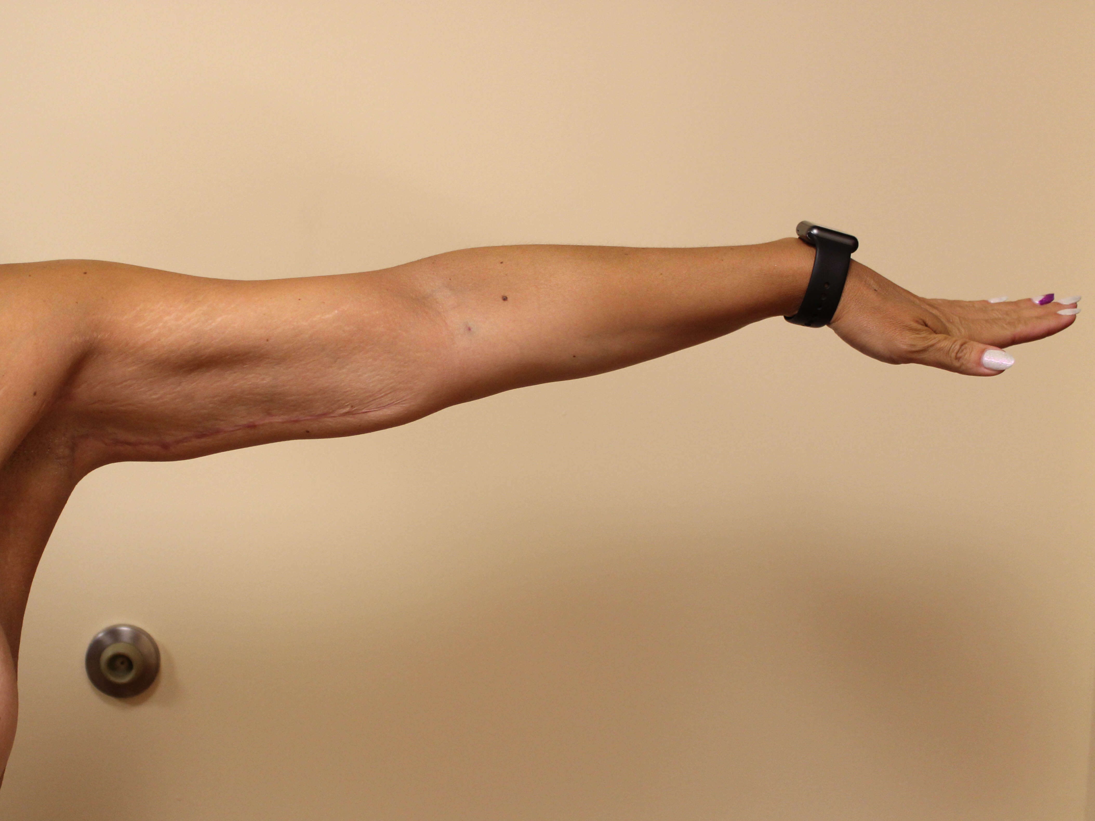 Brachioplasty Surgery After