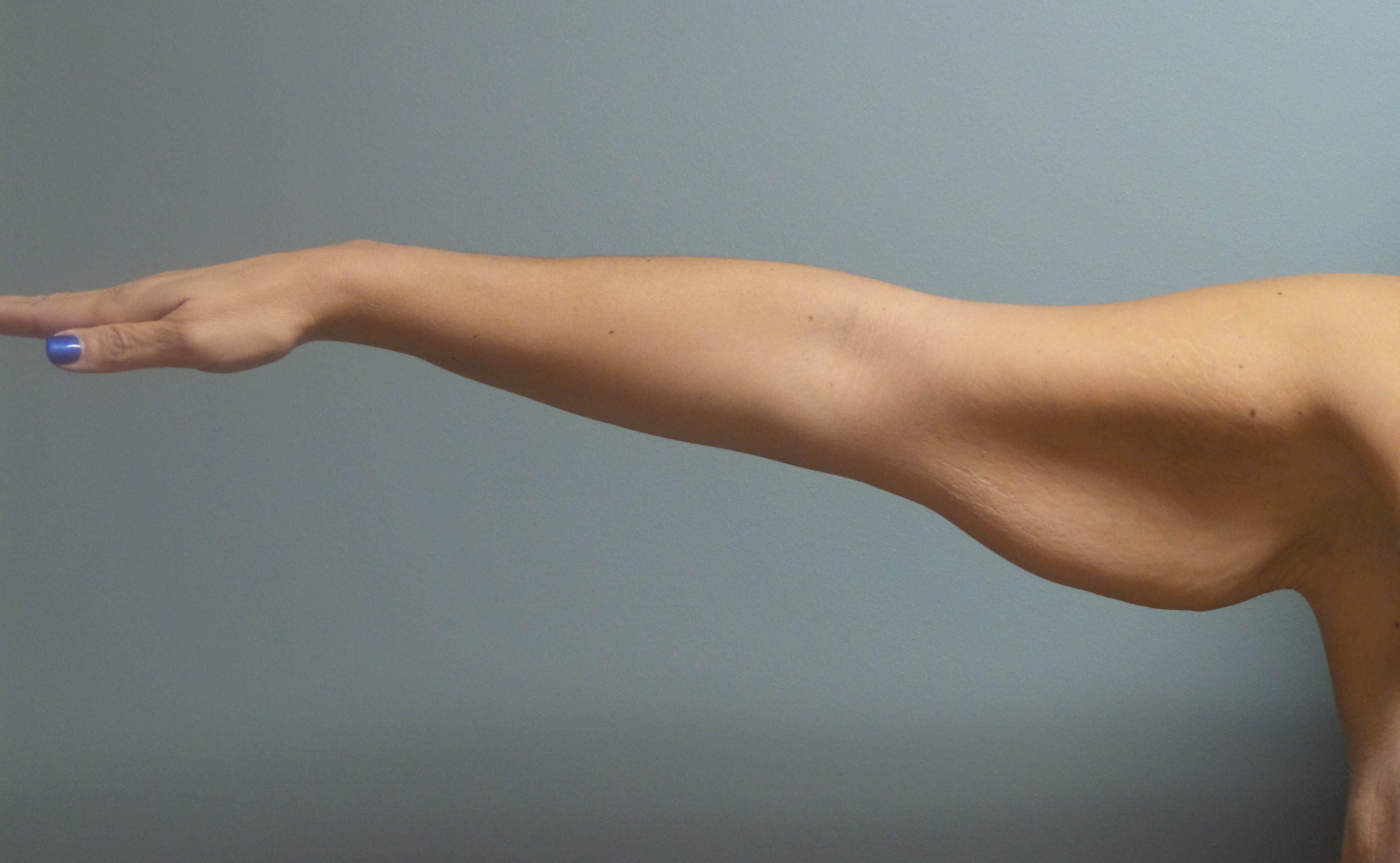 Brachioplasty Surgery Before