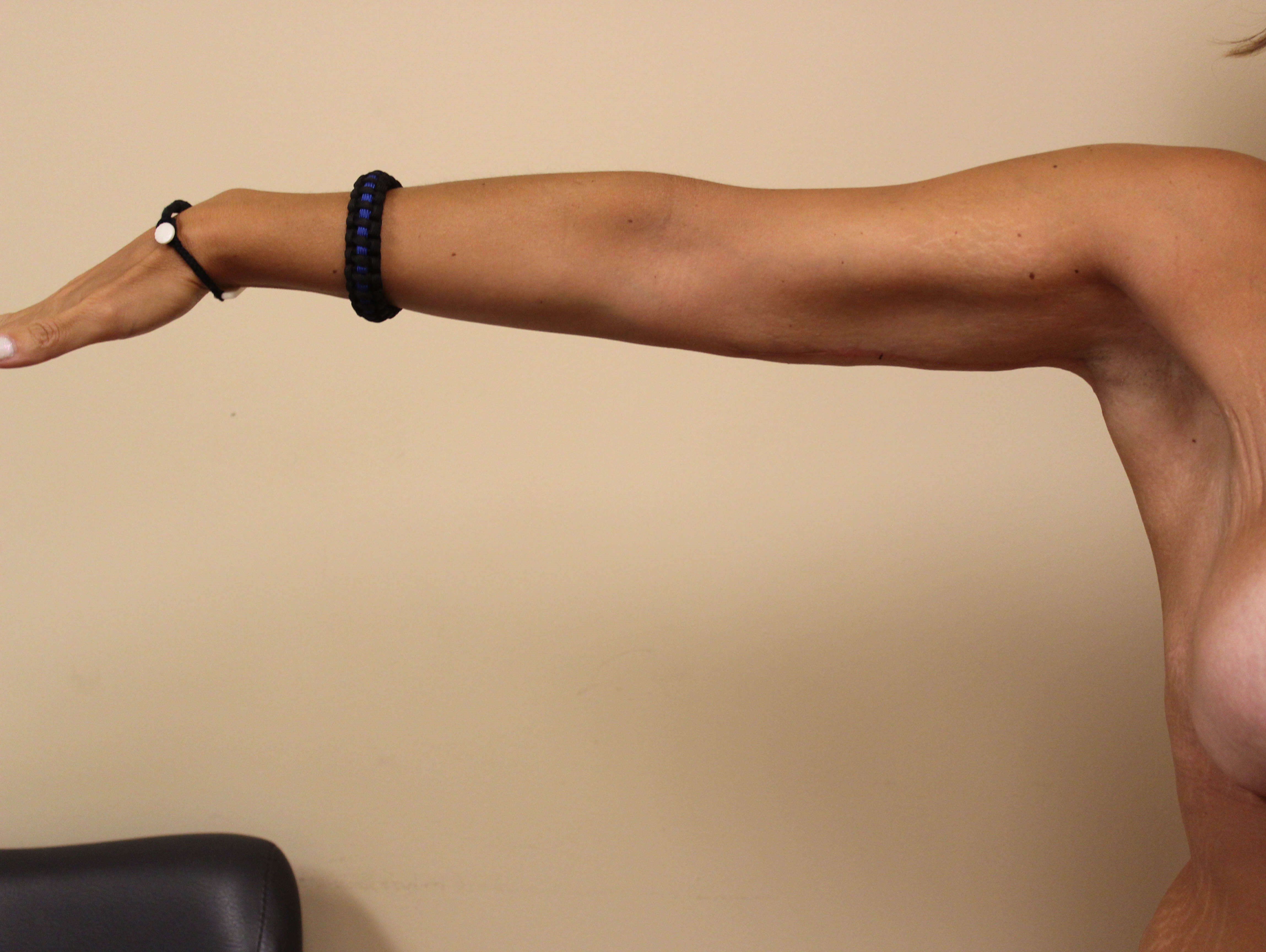 Brachioplasty Surgery After