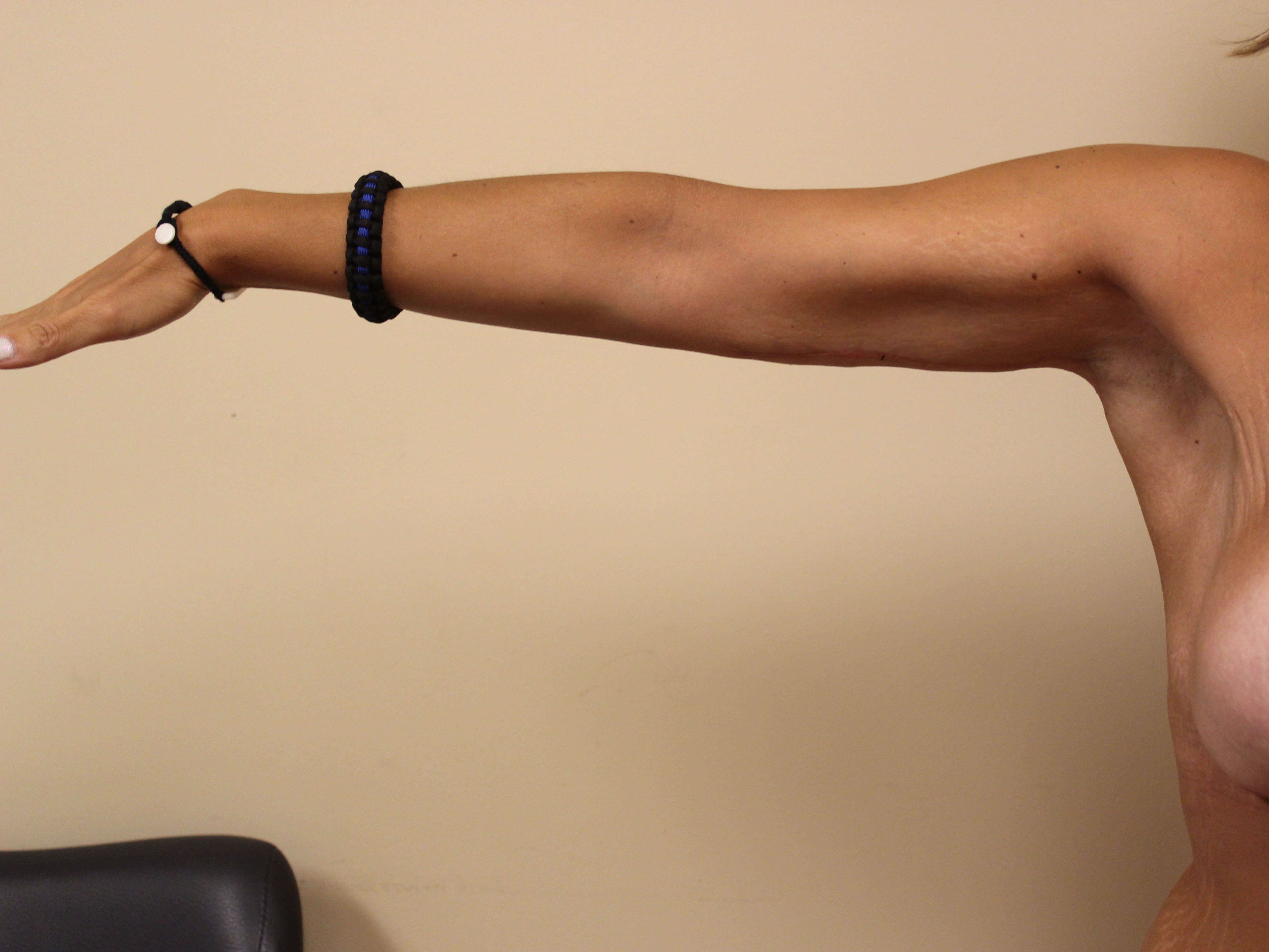 Brachioplasty Surgery After