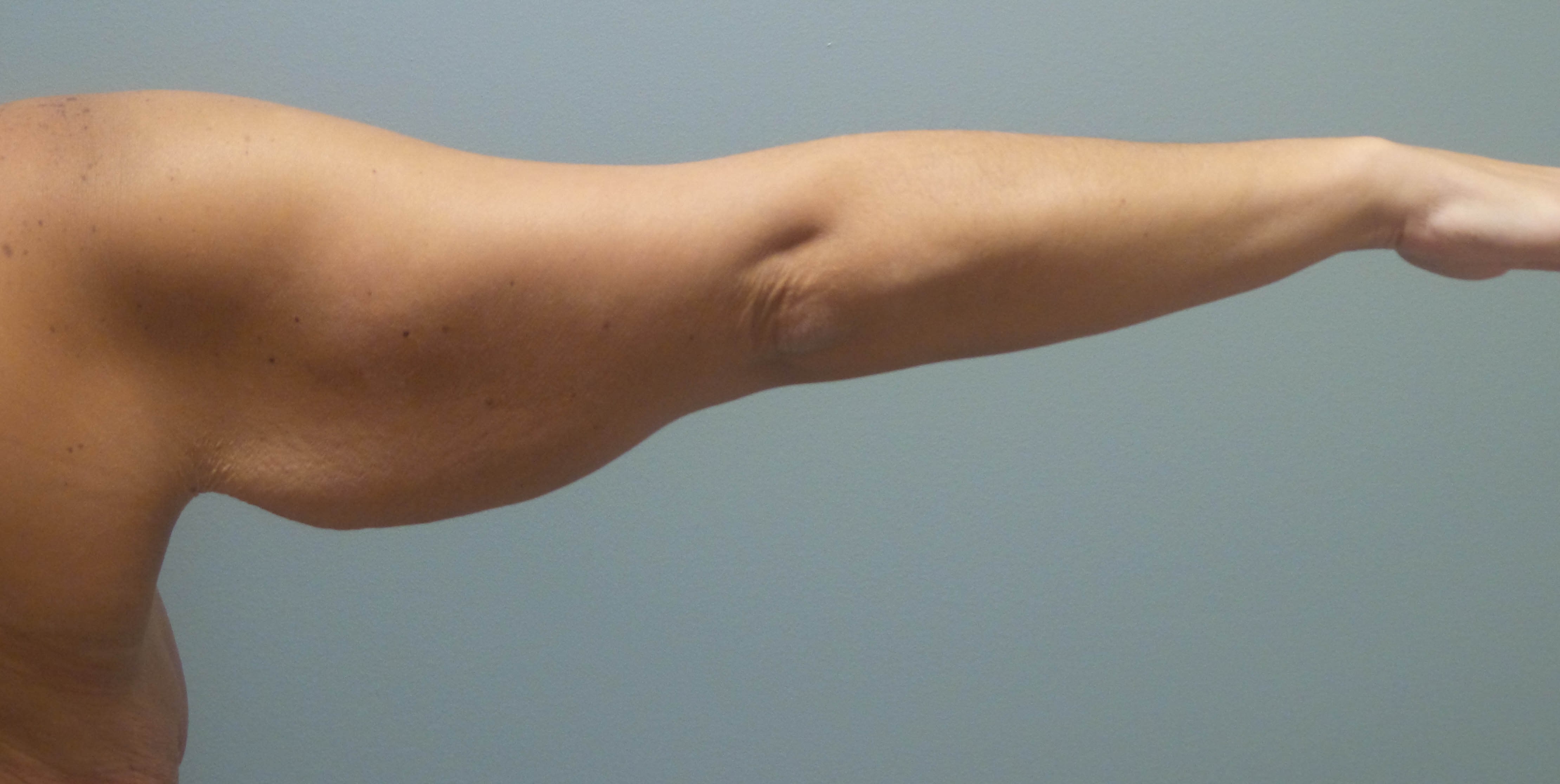 Brachioplasty Surgery Before