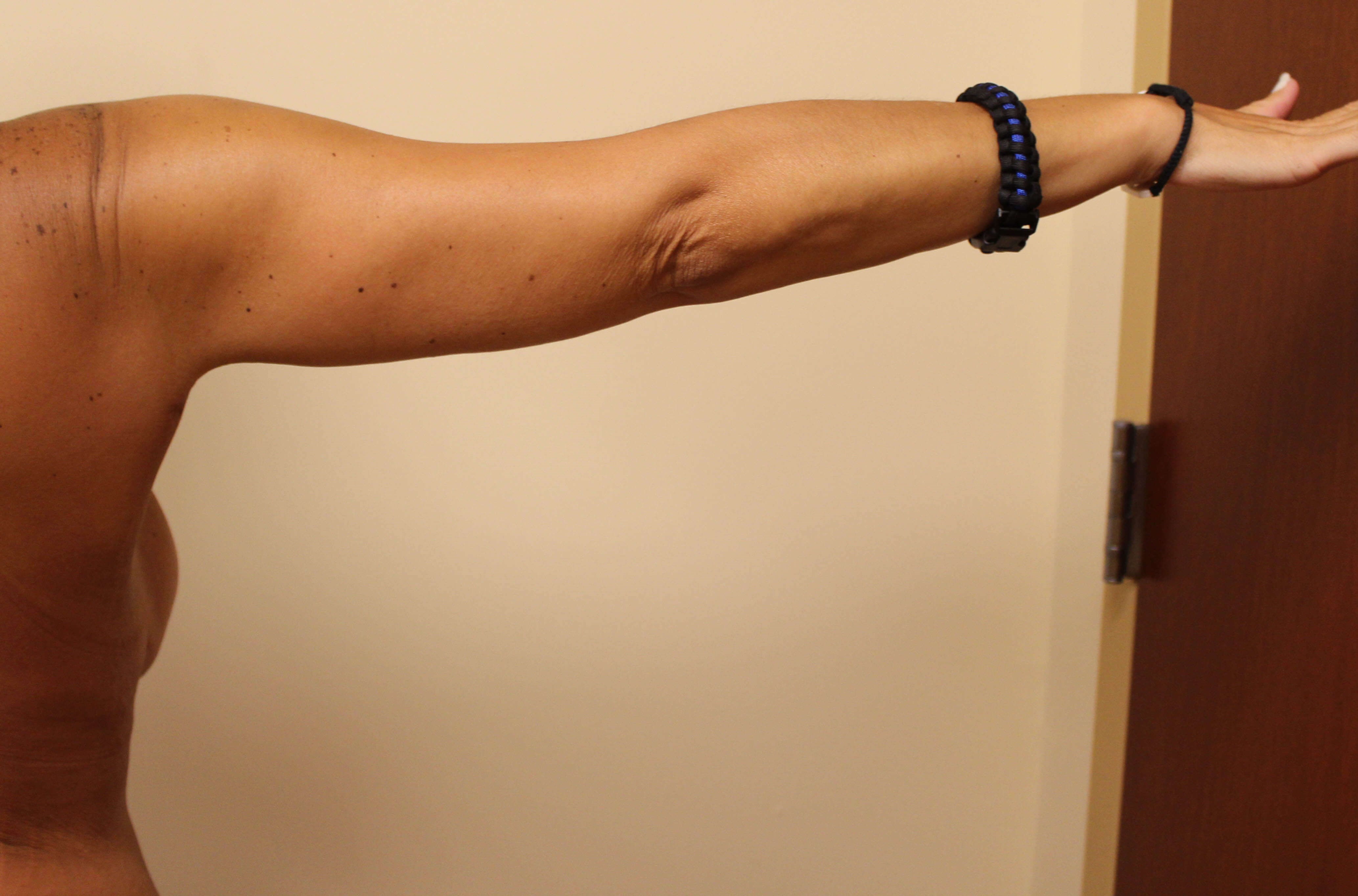 Brachioplasty Surgery After