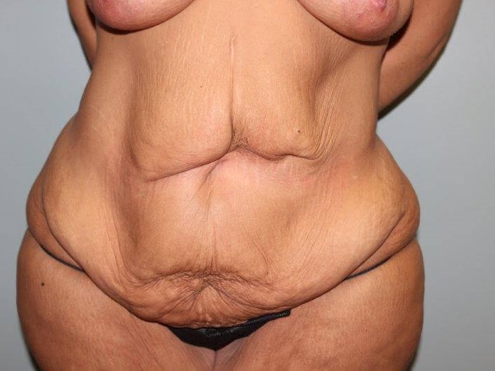 Tummy Tuck after weight loss Before Front View