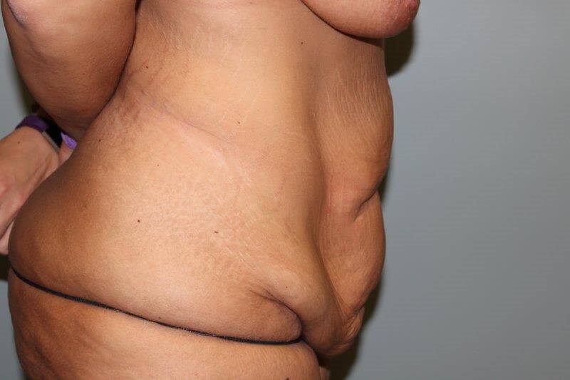 Tummy Tuck after weight loss Before Side View