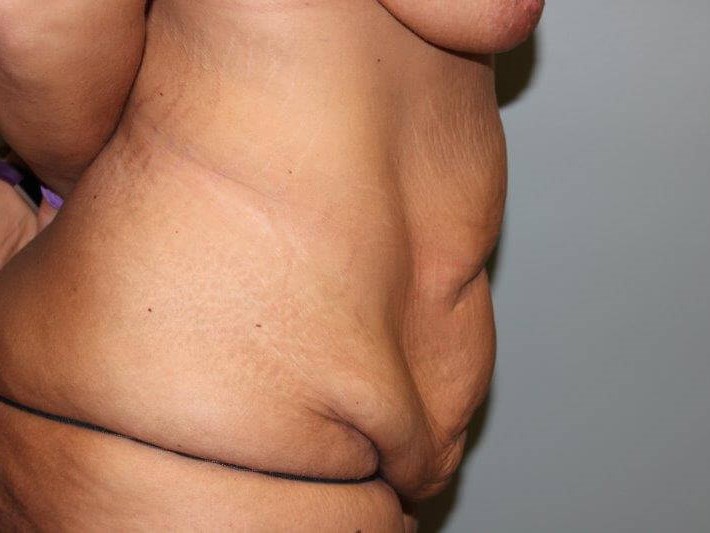 Tummy Tuck after weight loss Before Side View