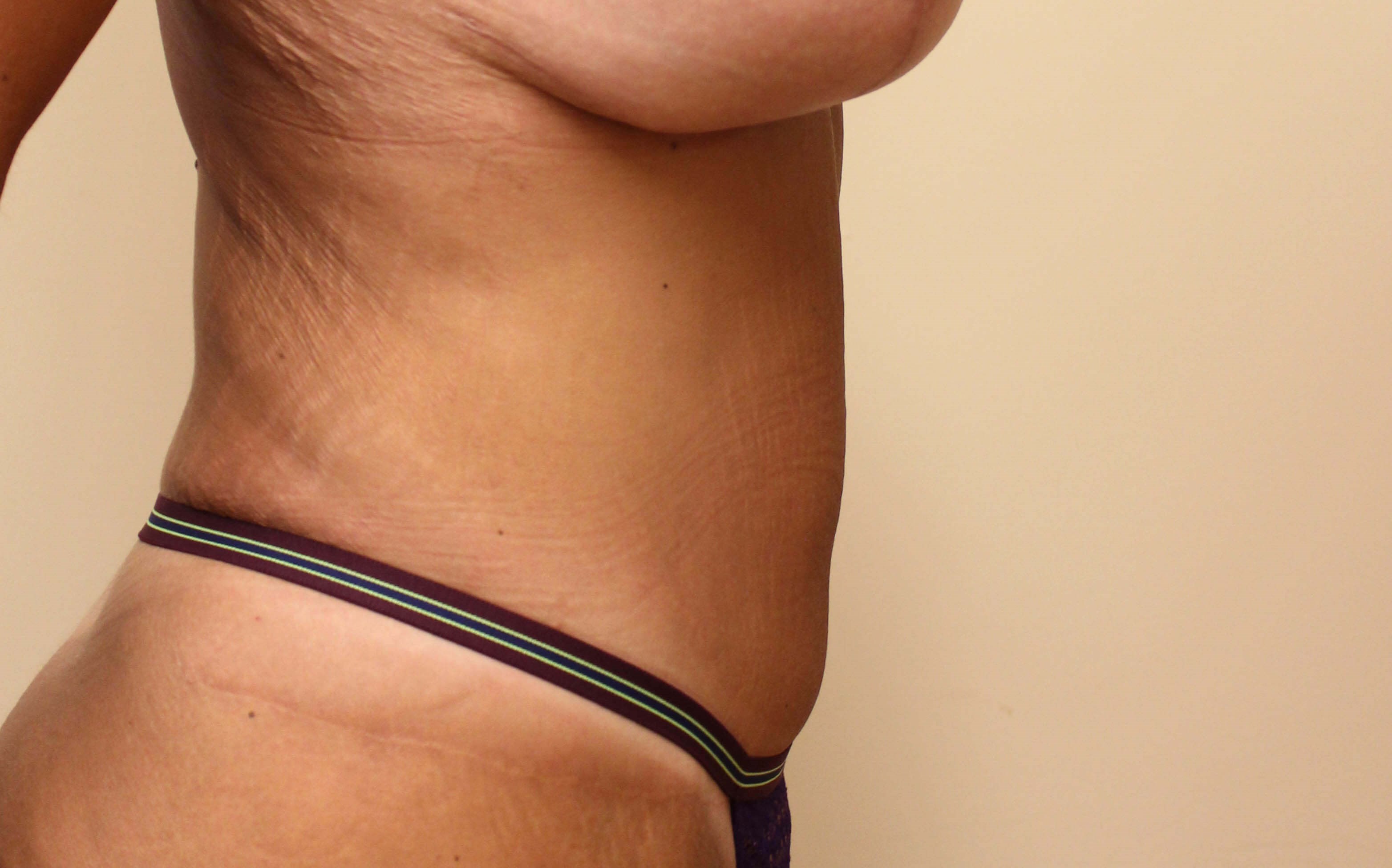 Tummy Tuck after weight loss After Side View