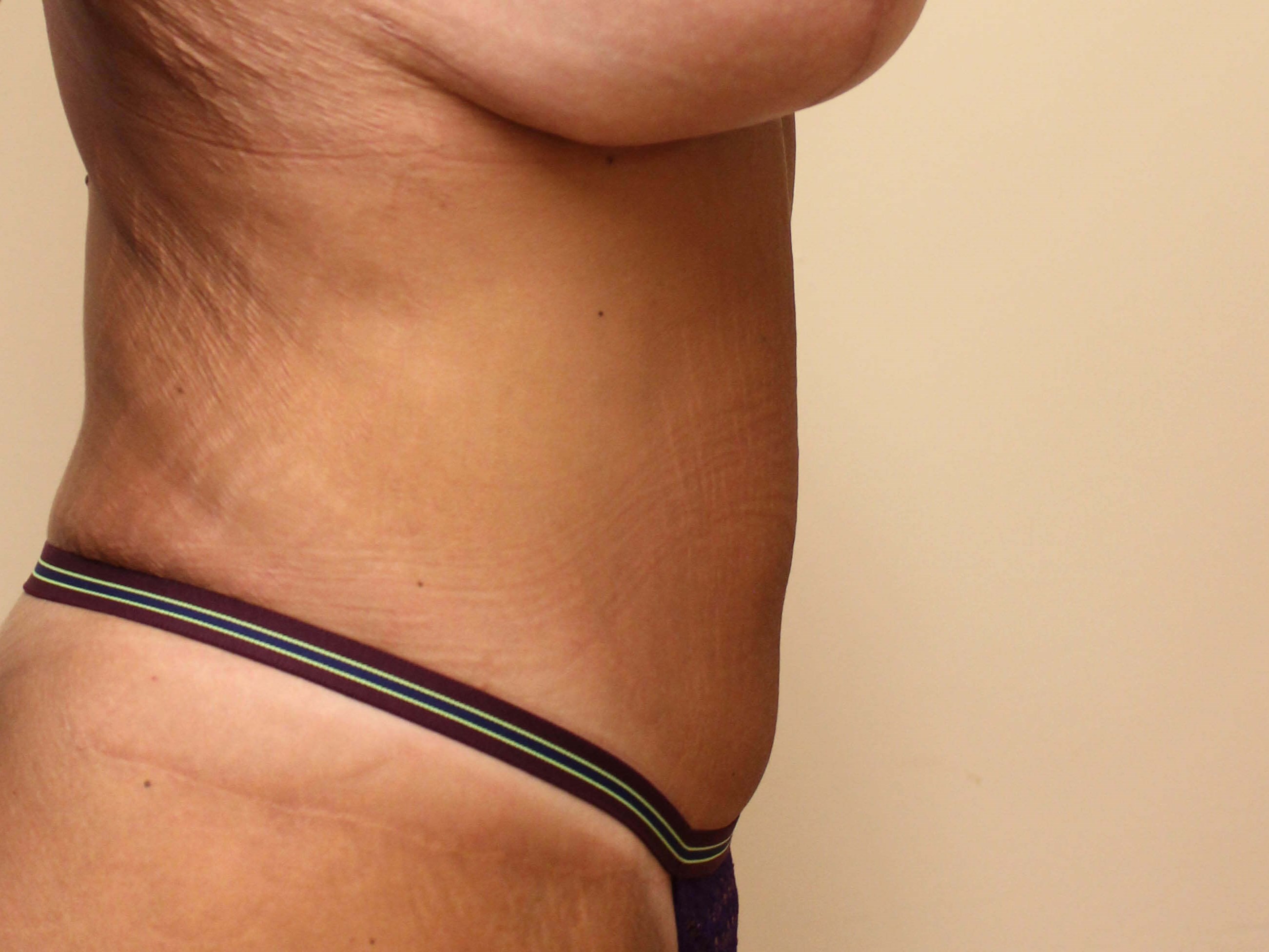 Tummy Tuck after weight loss After Side View