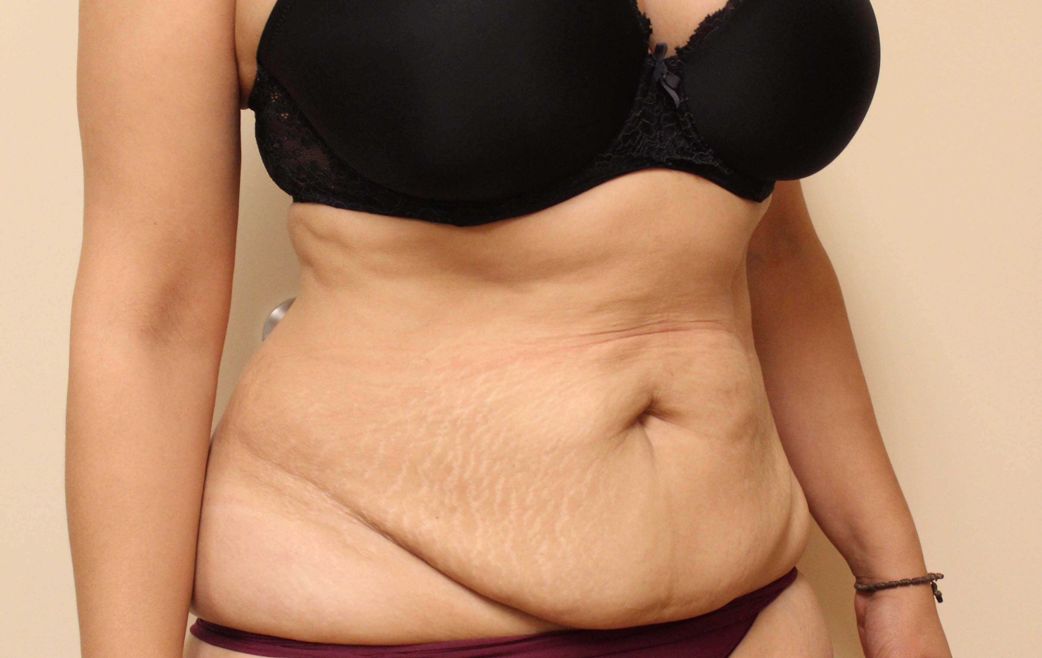 Abdominoplasty Surgery Before