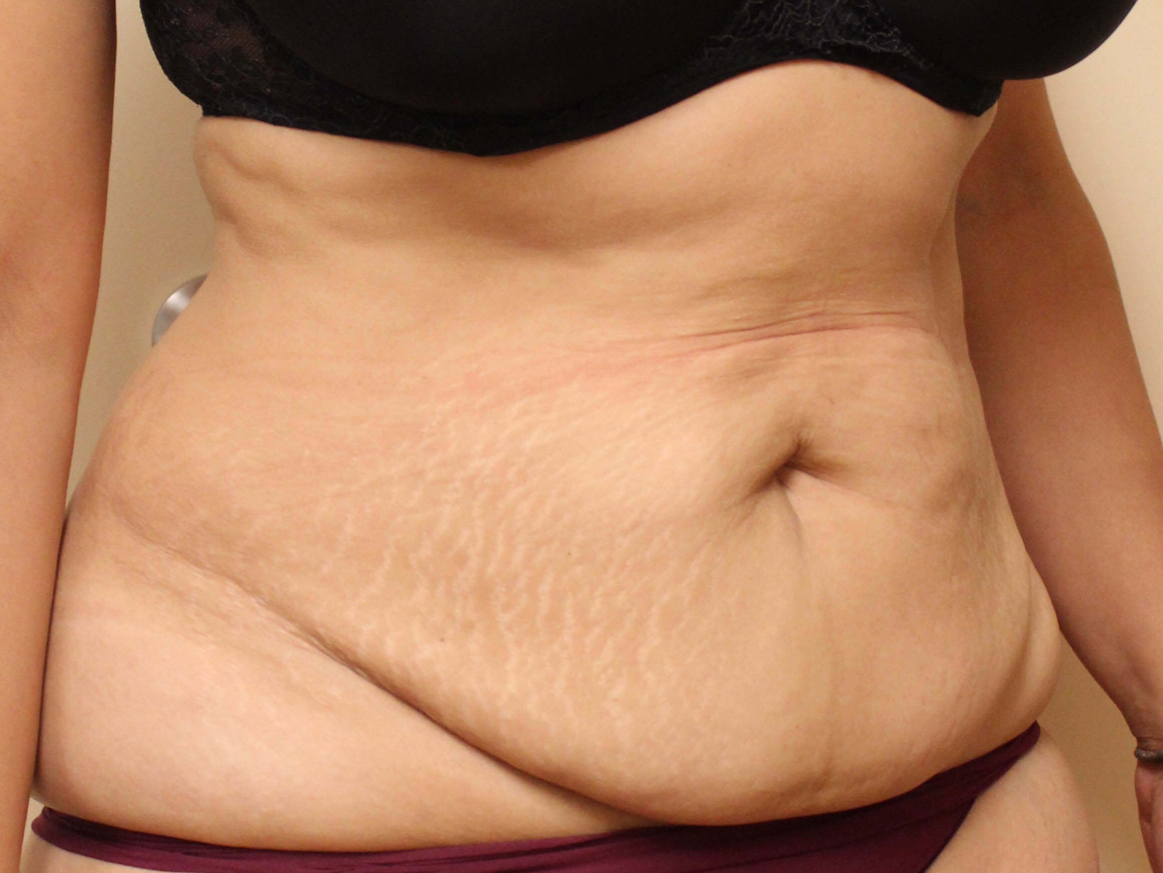Abdominoplasty Surgery Before