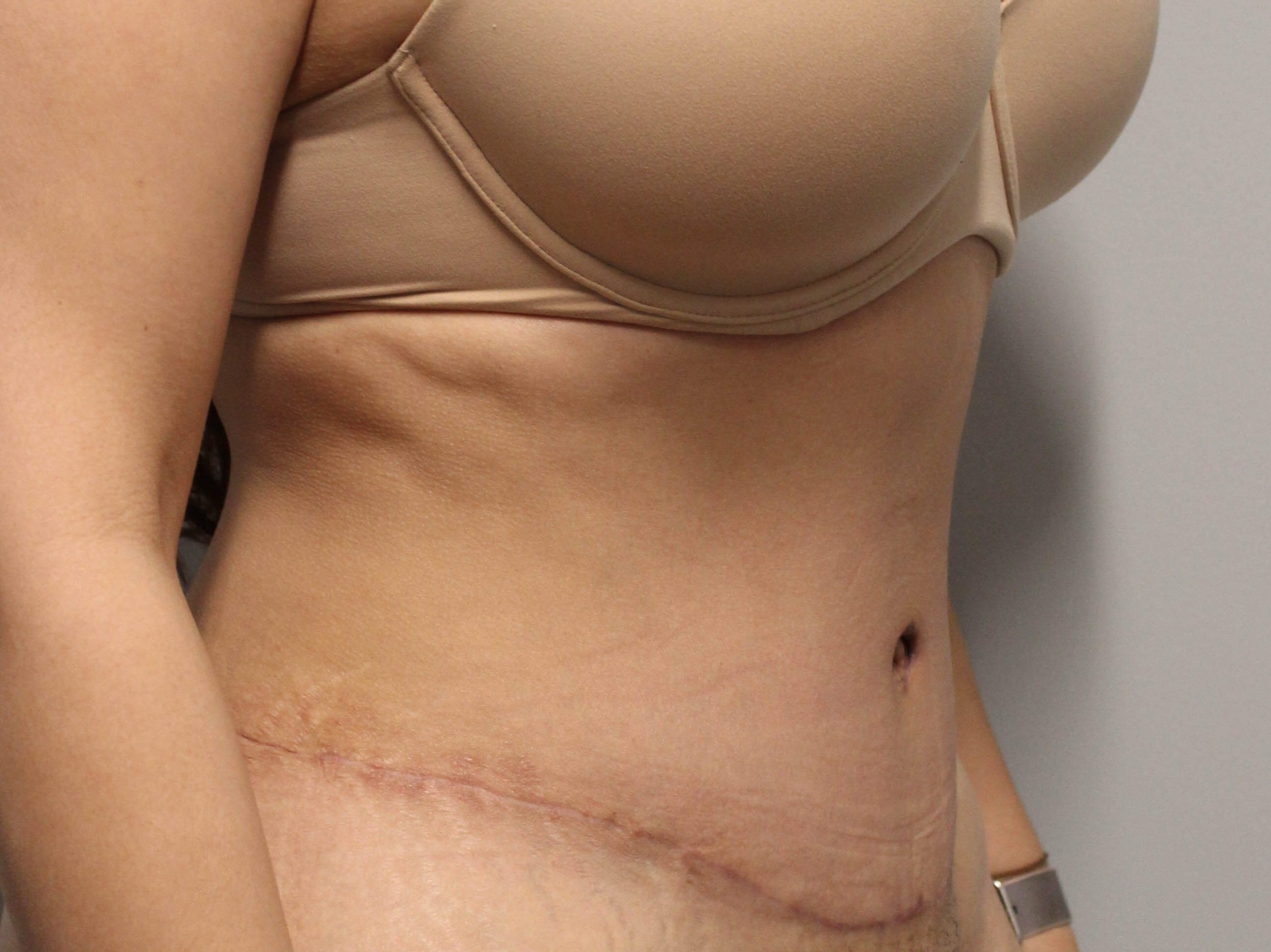 Abdominoplasty Surgery After