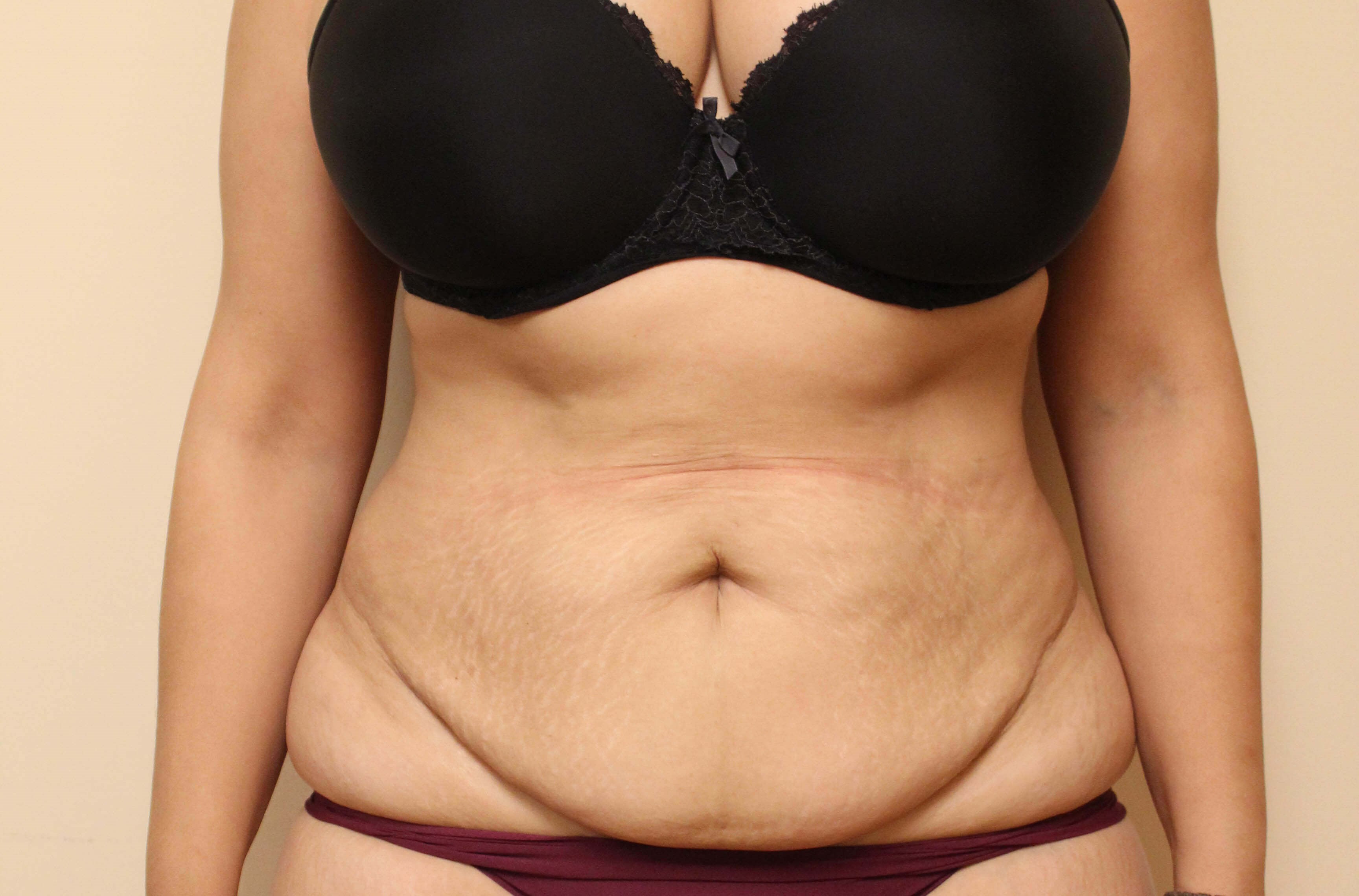 Abdominoplasty Surgery Before