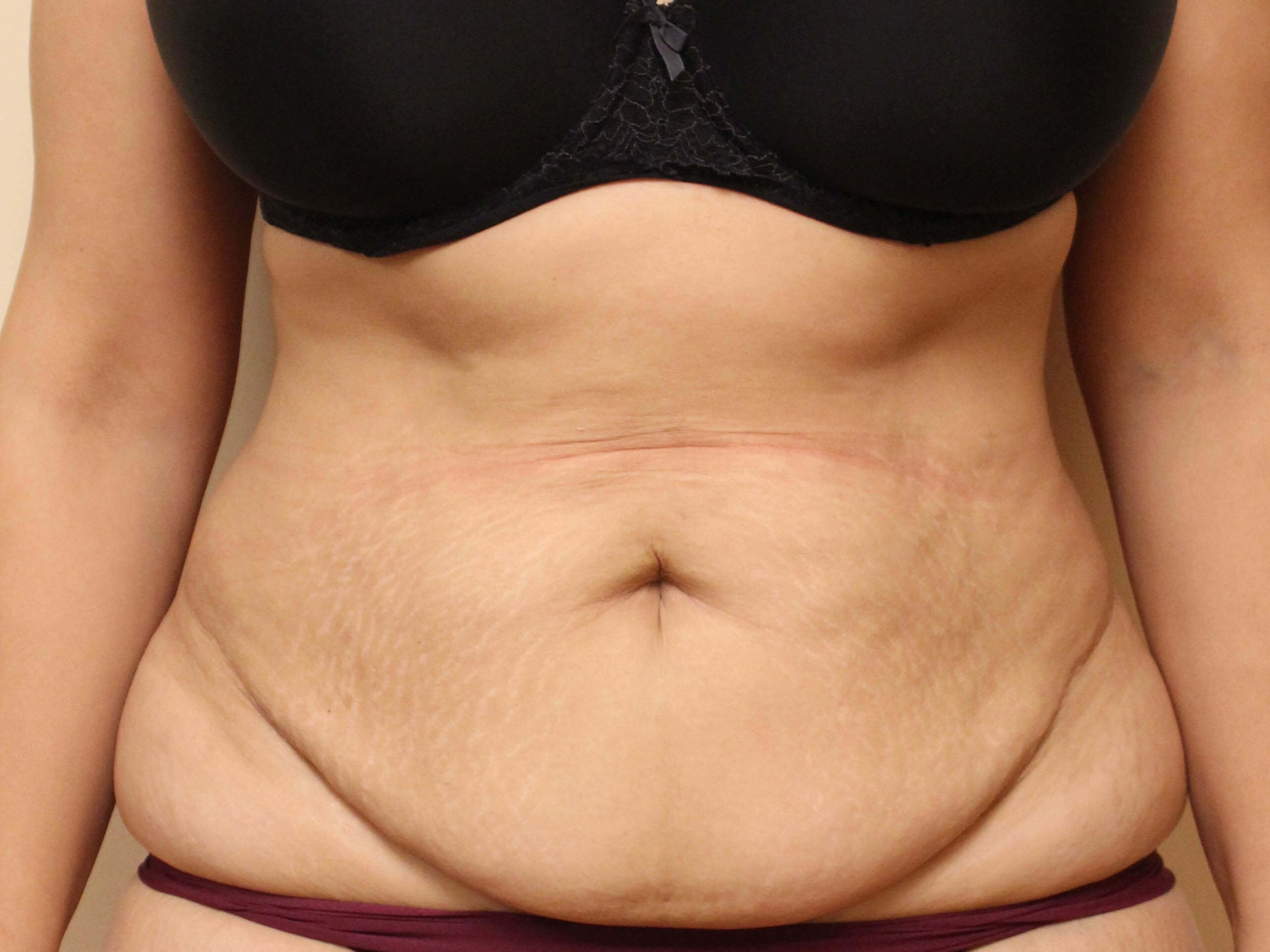Abdominoplasty Surgery Before