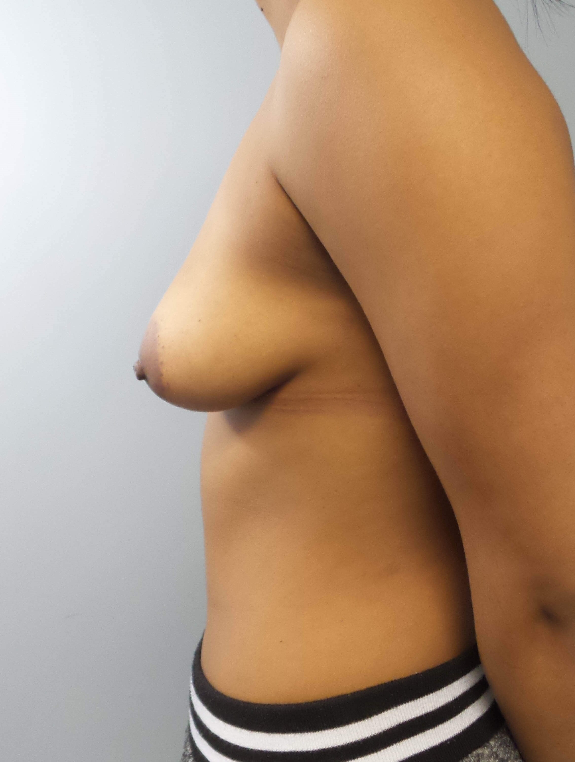Breast Augmentation Before