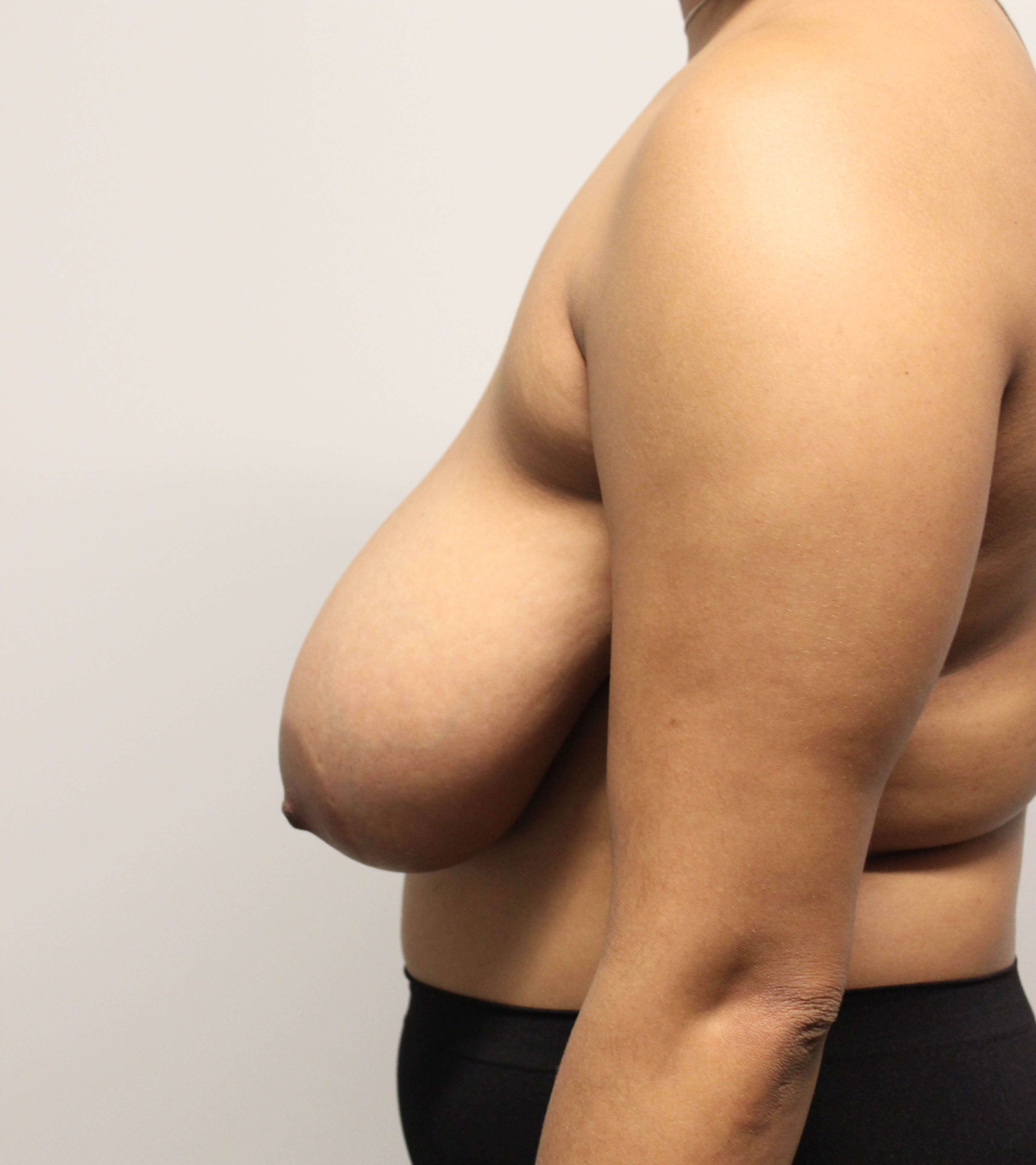 Breast Reduction Before