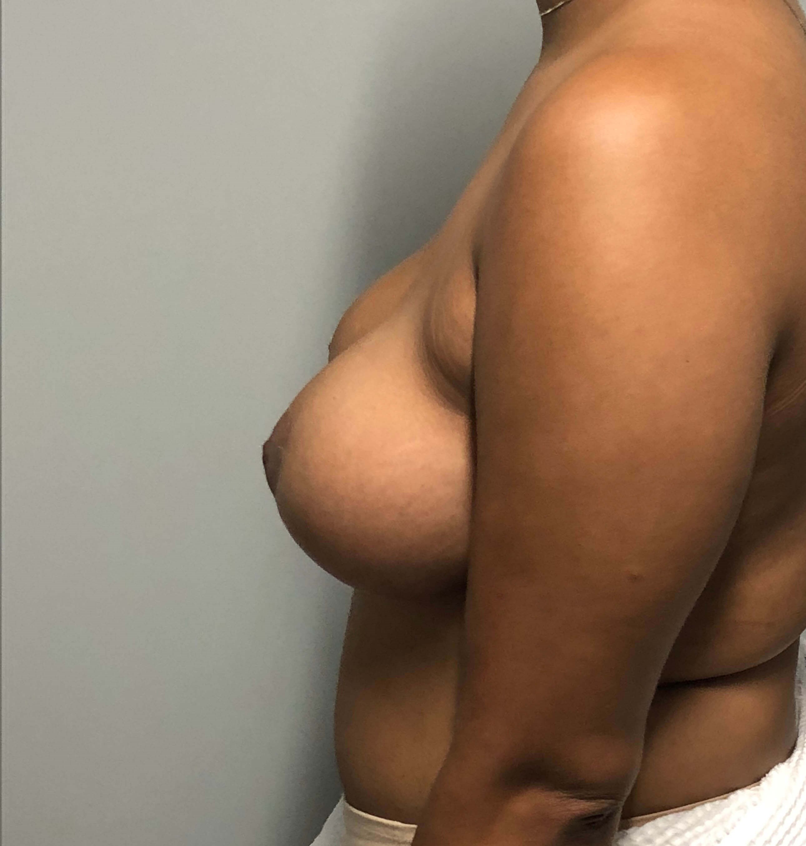 Breast Reduction After