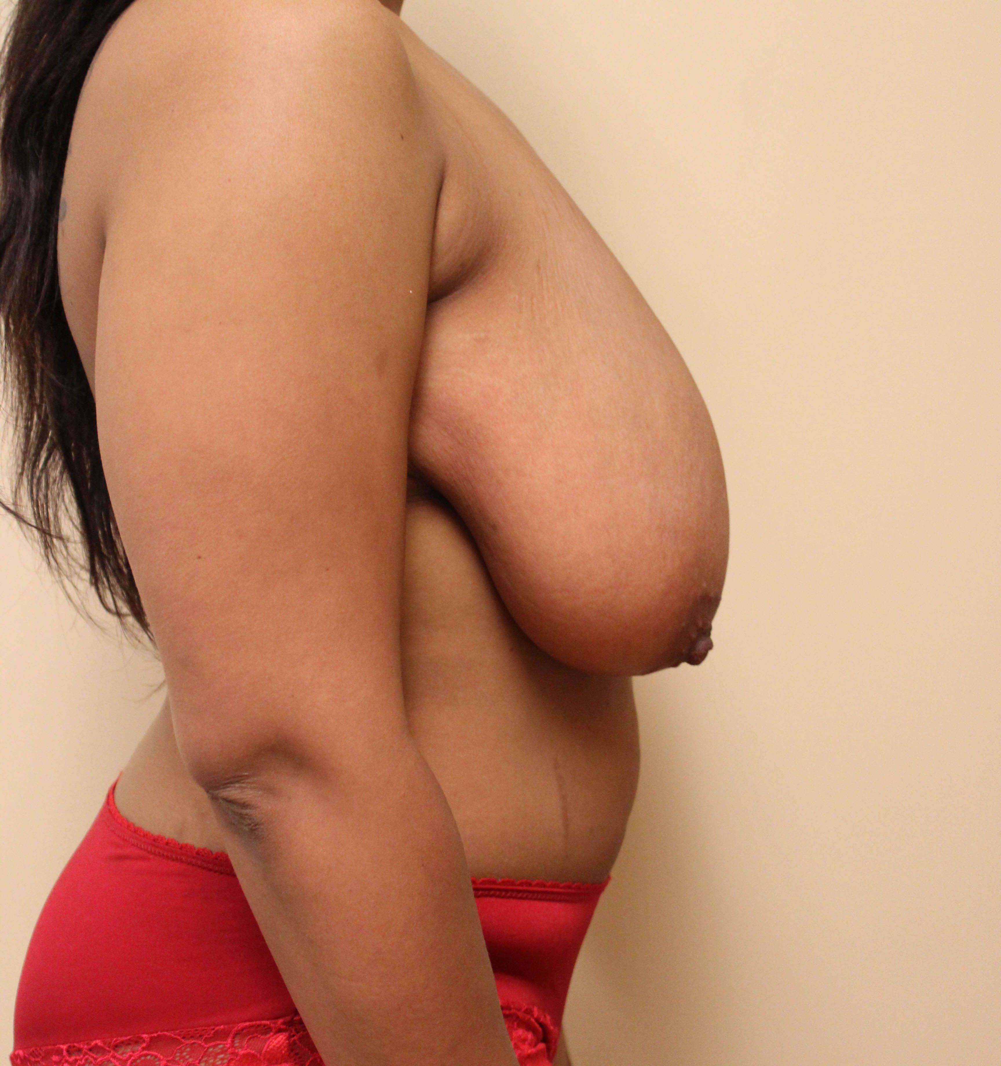 Breast Reduction Before