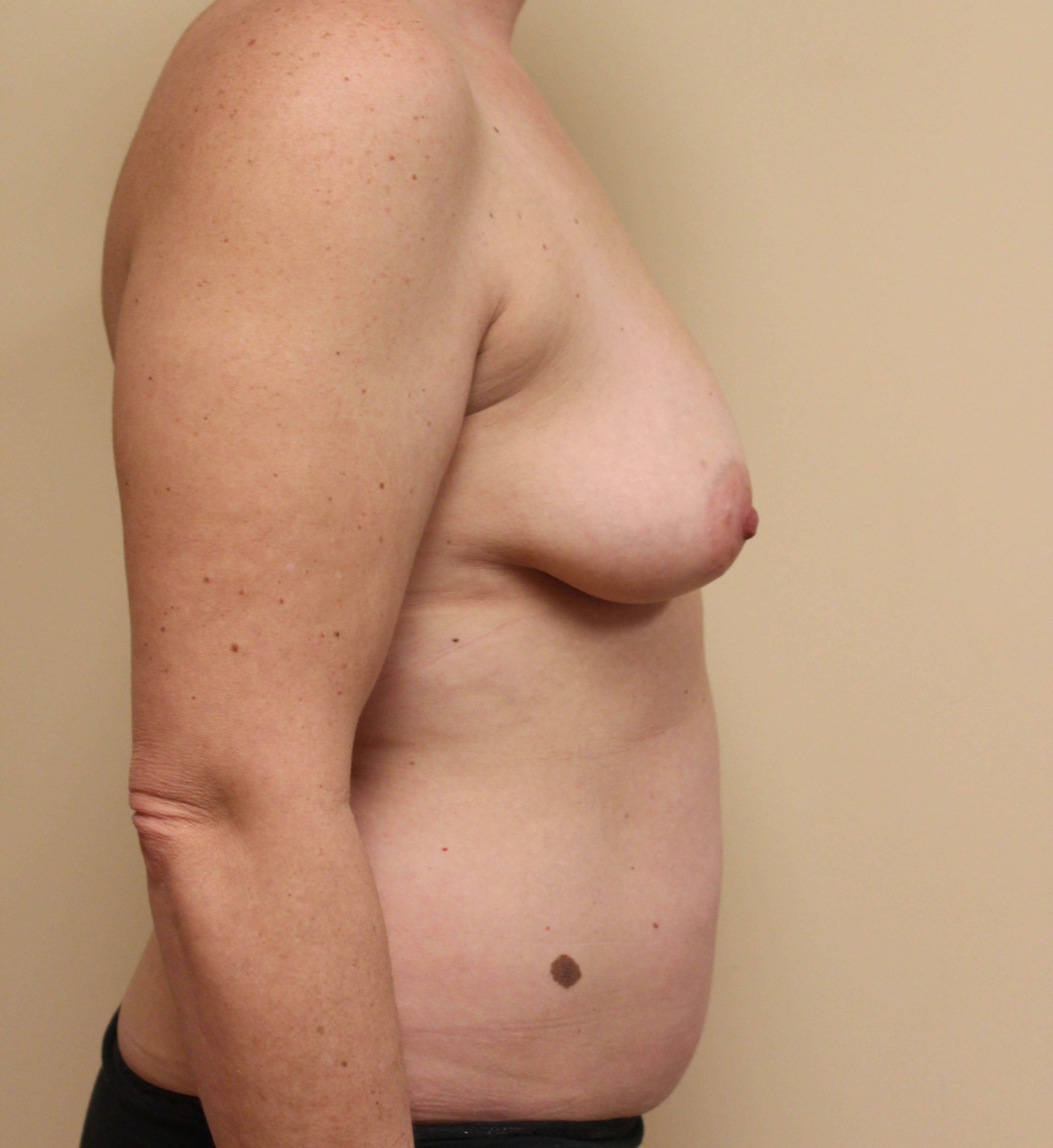 Breast Reconstruction Before