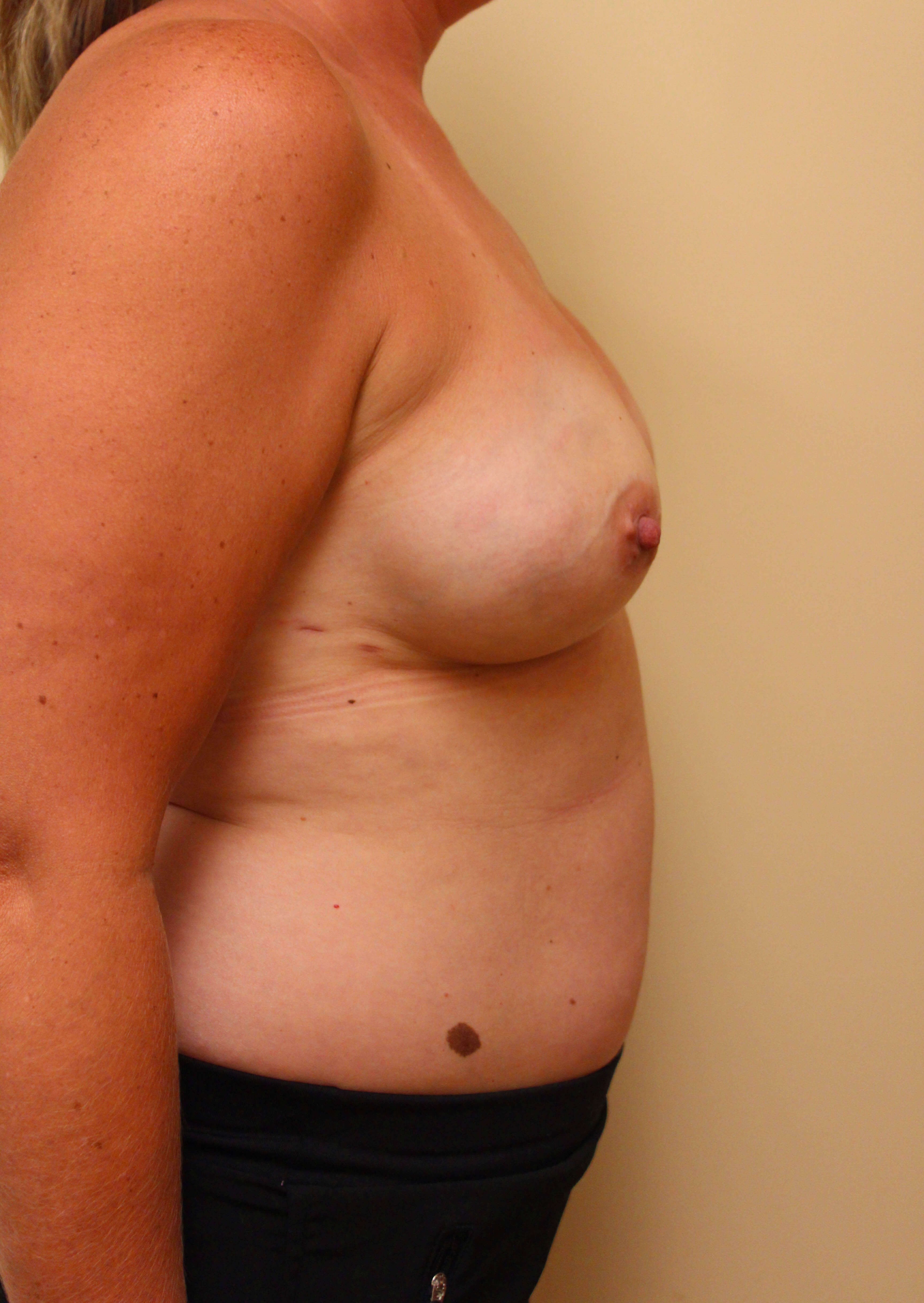 Breast Reconstruction After