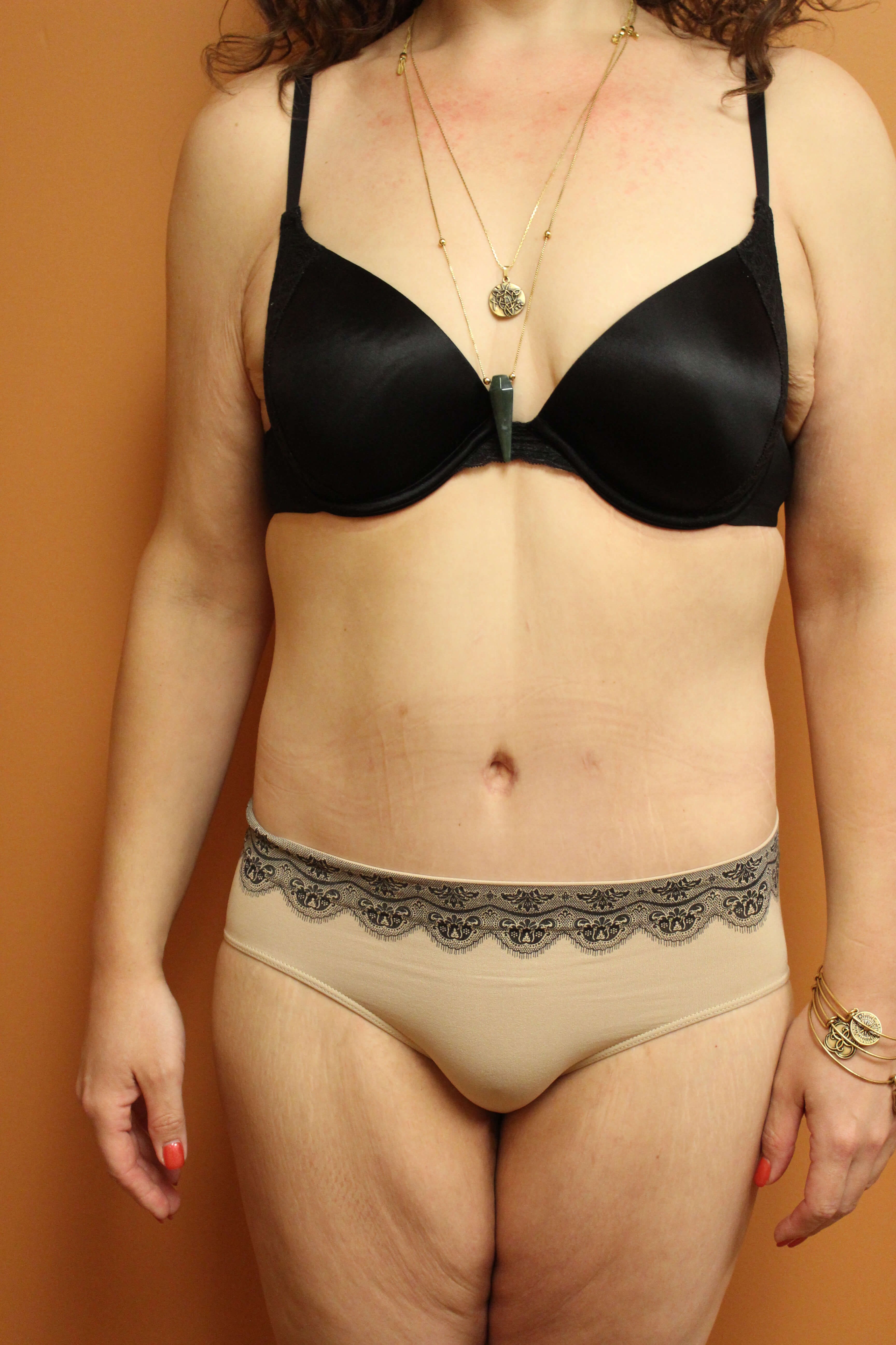 Tummy Tuck Surgery After