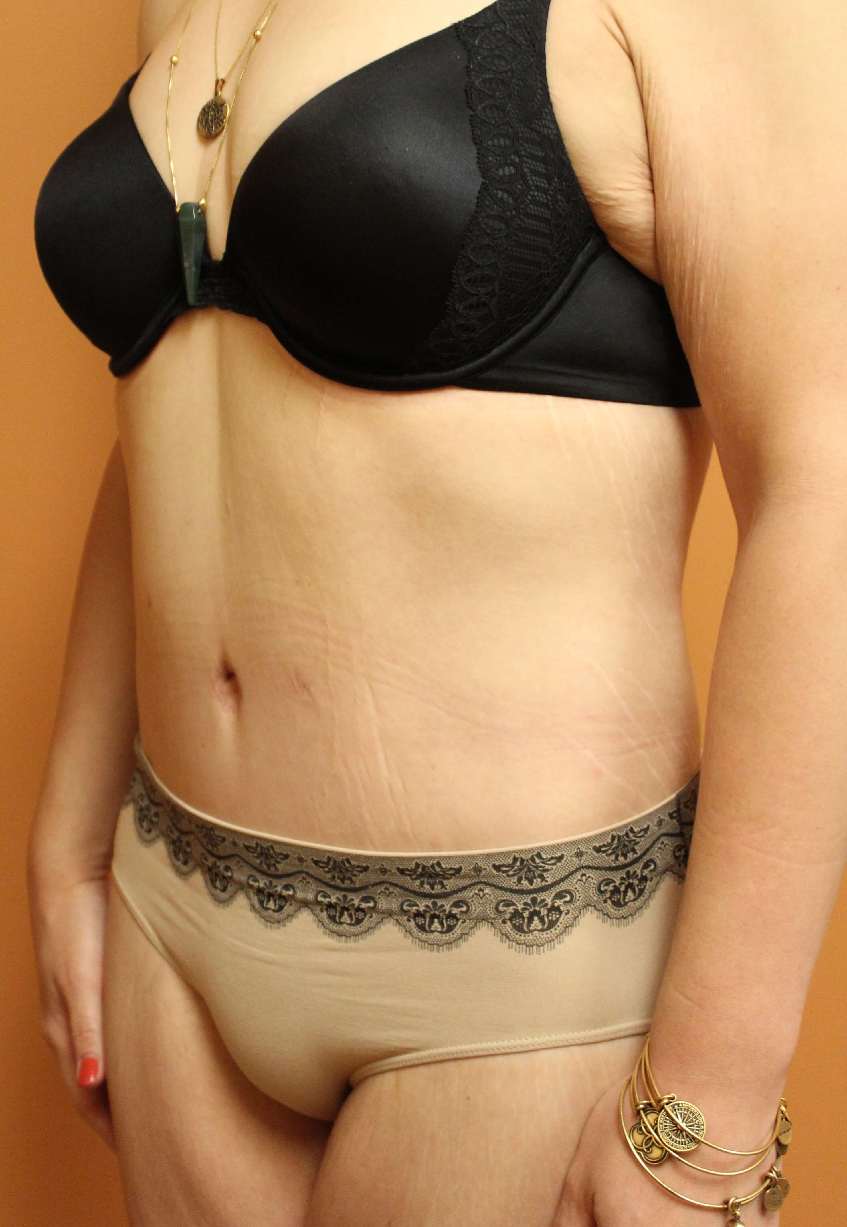 Tummy Tuck Surgery After