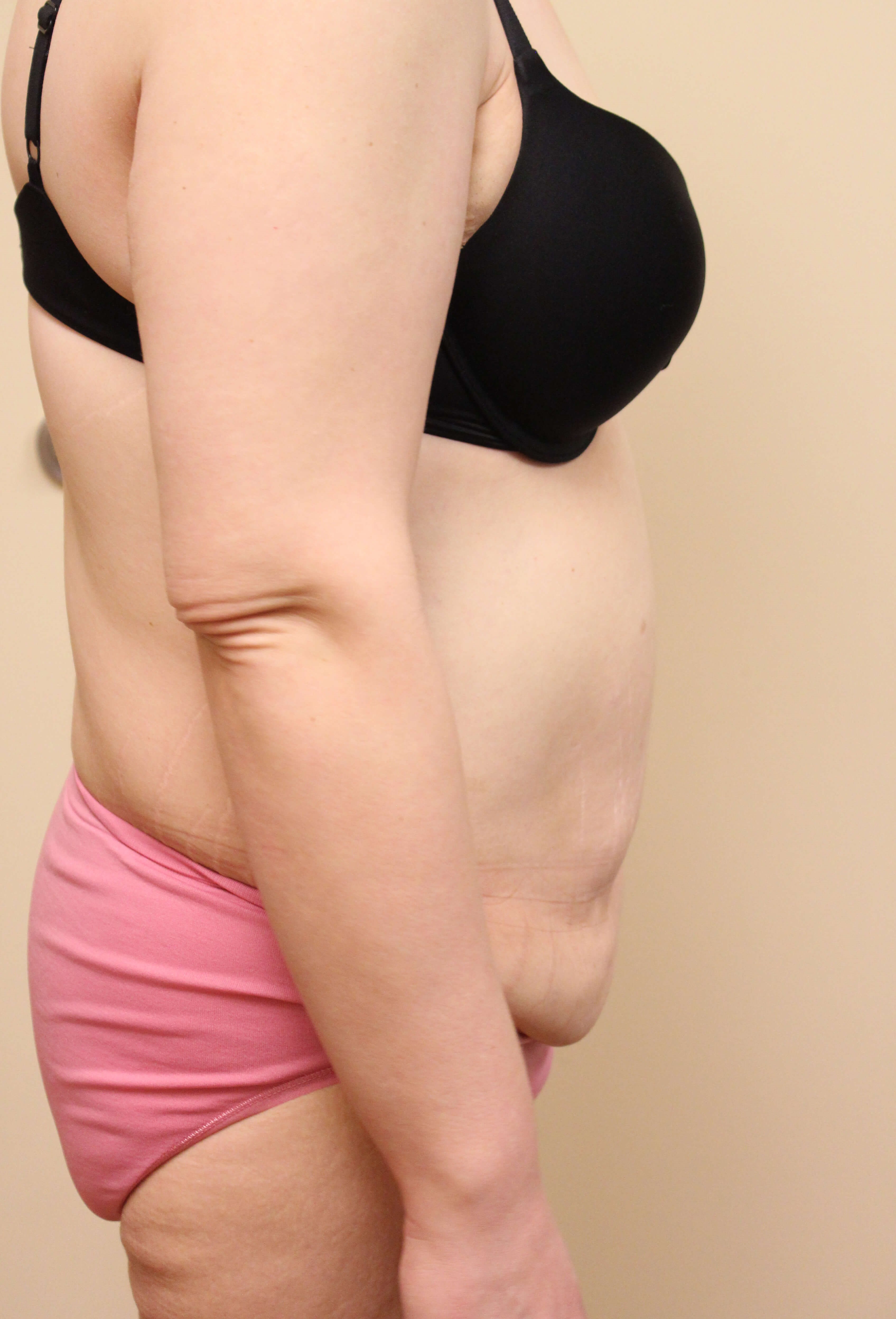 Tummy Tuck Surgery Before