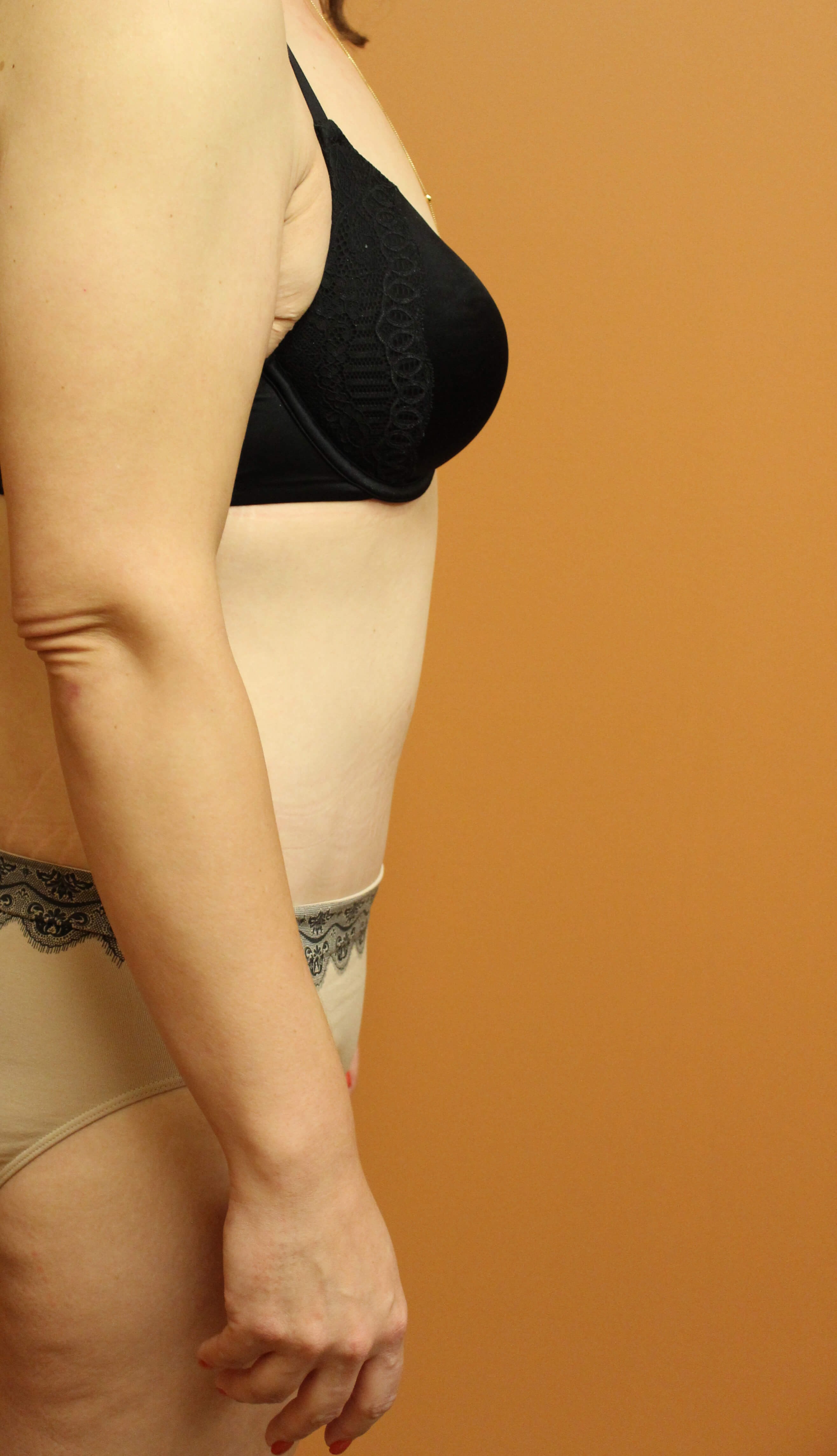 Tummy Tuck Surgery After