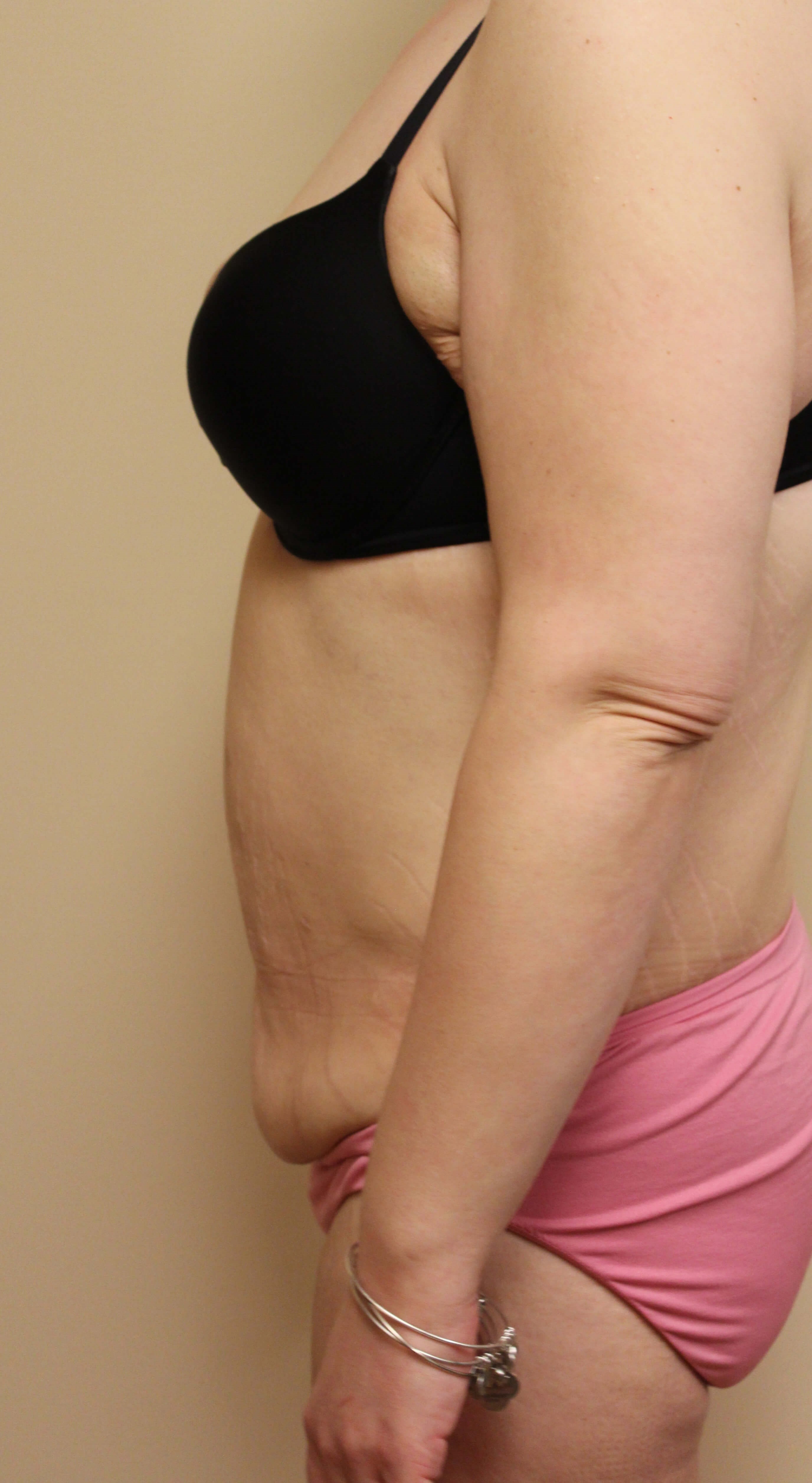 Tummy Tuck Surgery Before