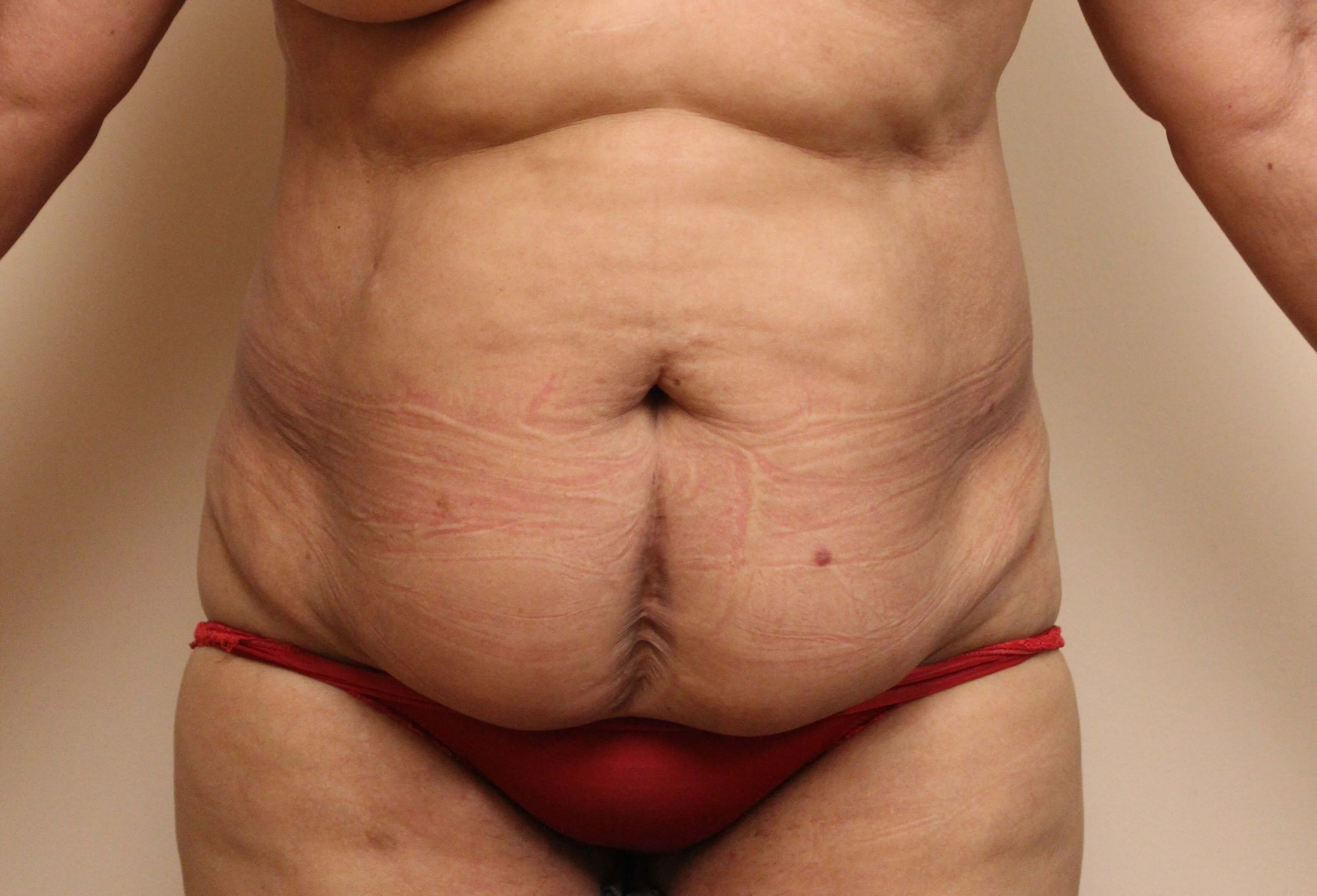 Abdominoplasty Surgery Before