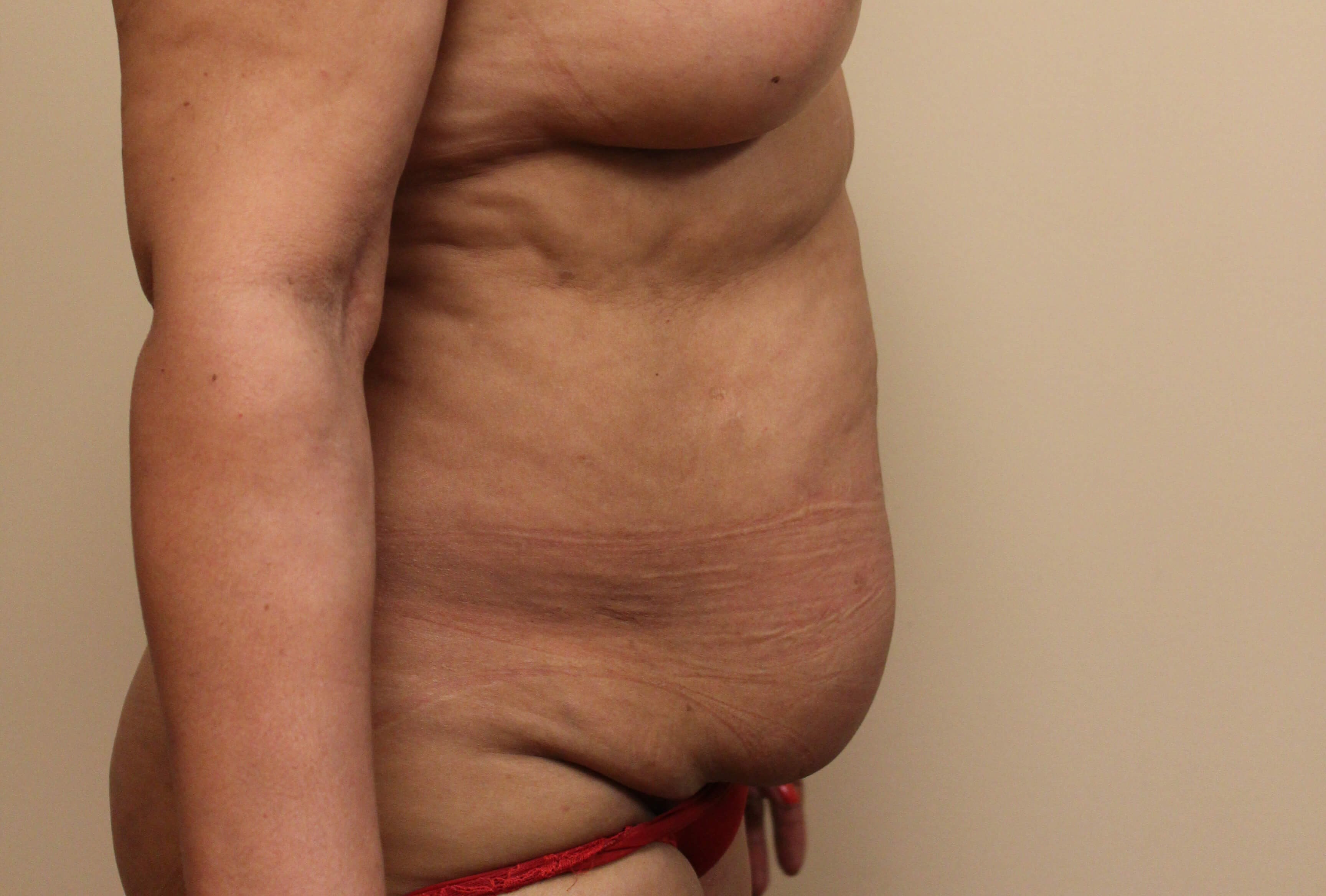 Abdominoplasty Surgery Before
