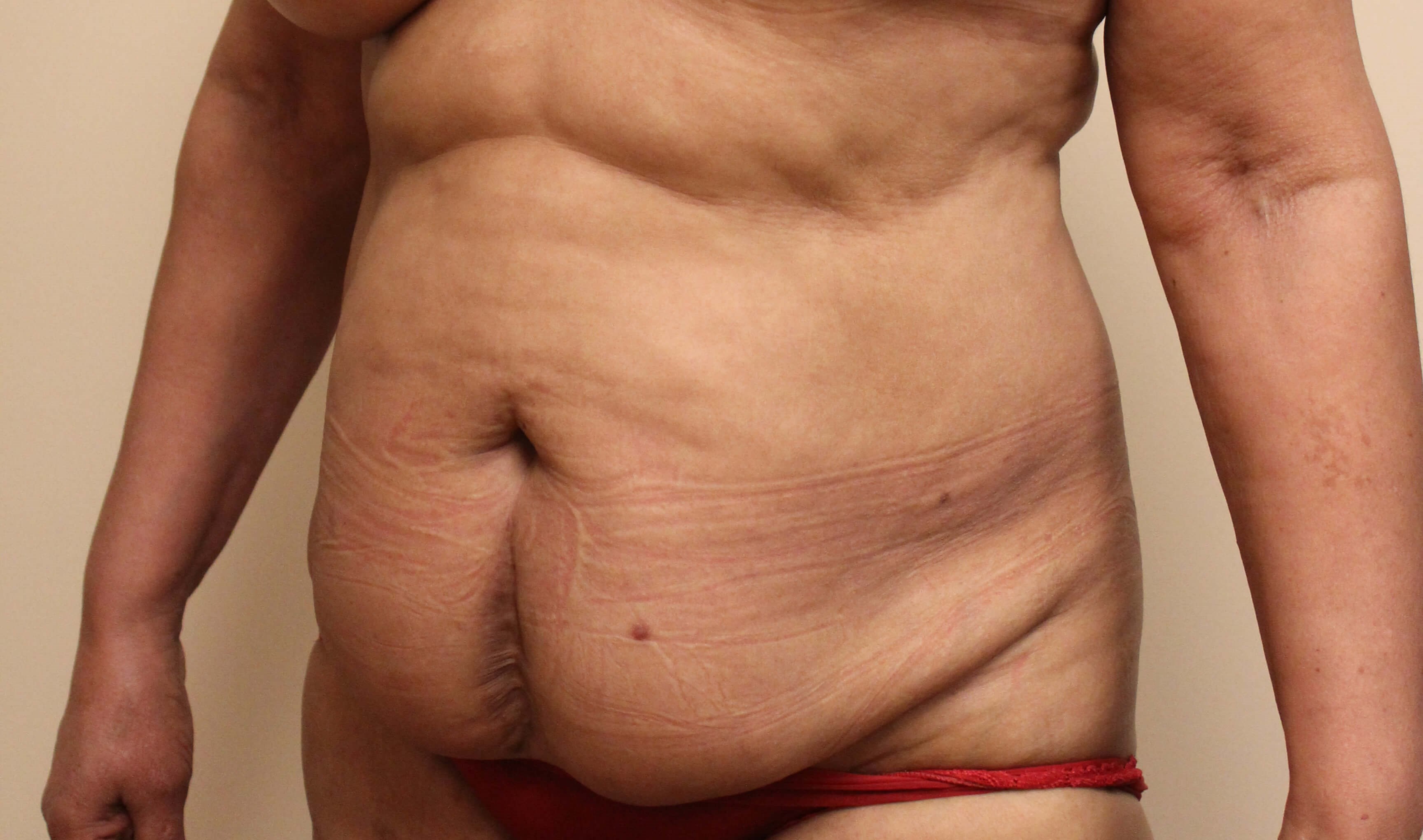 Abdominoplasty Before