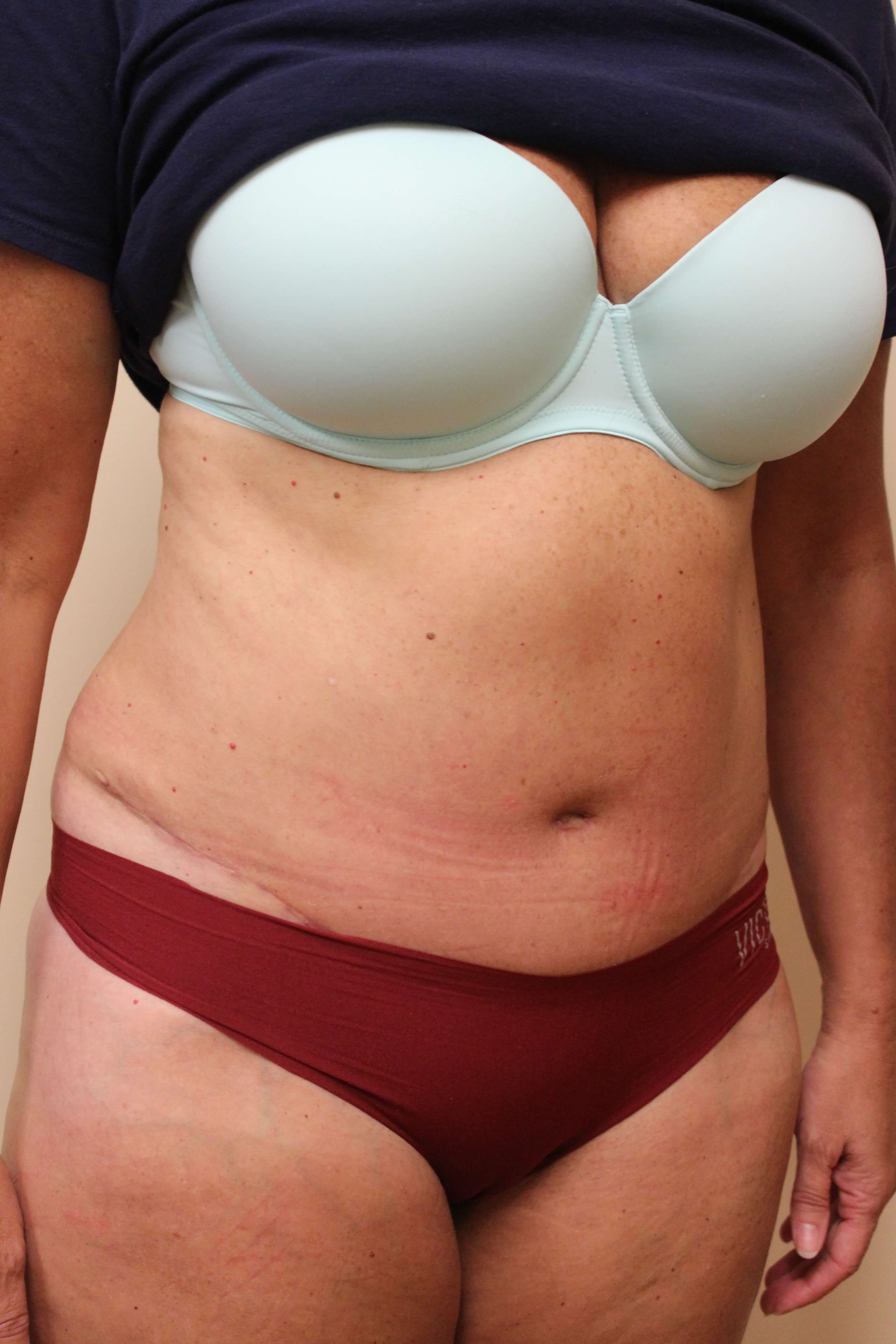Tummy Tuck Surgery After