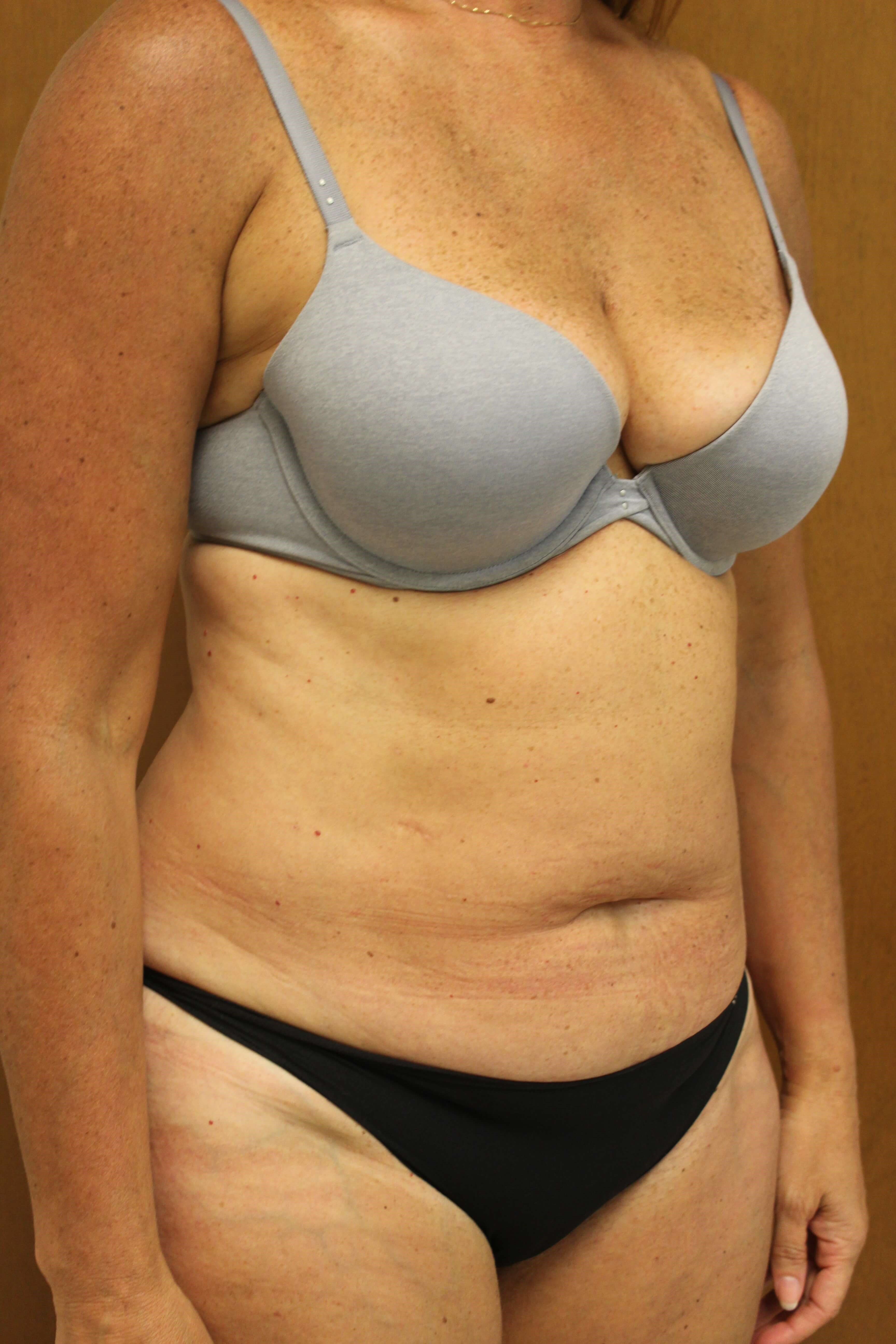 Tummy Tuck Surgery Before