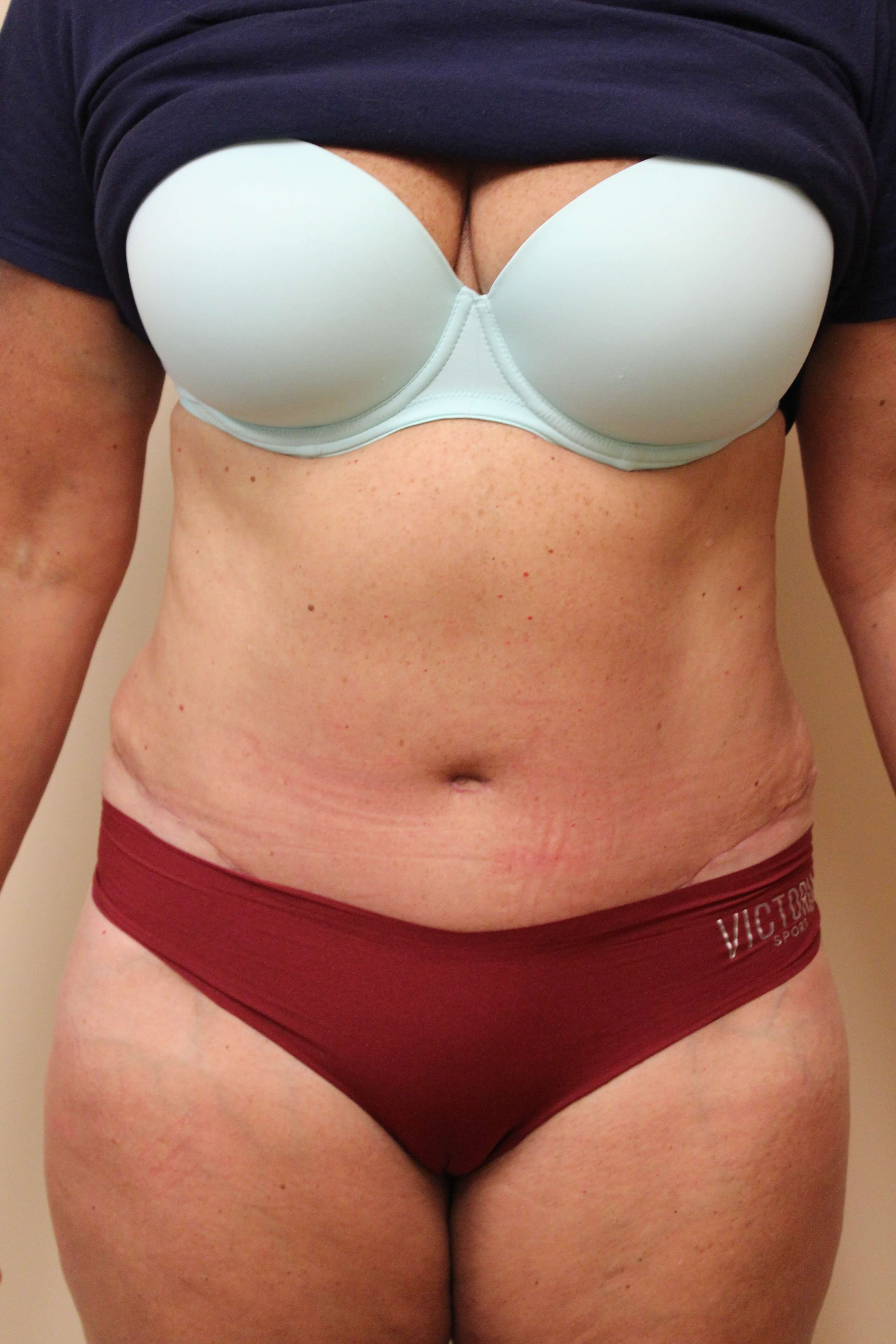 Tummy Tuck Surgery After