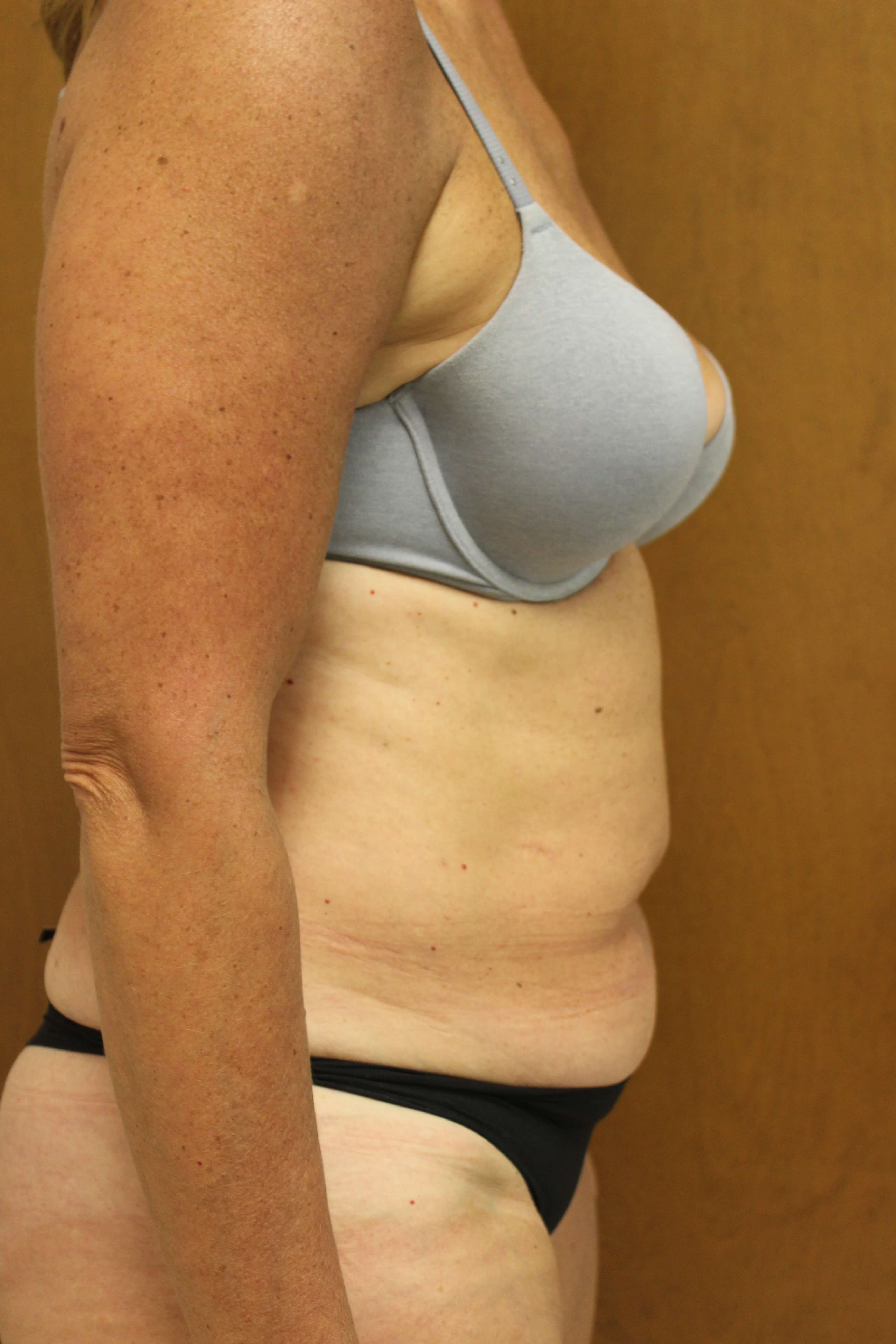 Tummy Tuck Surgery Before
