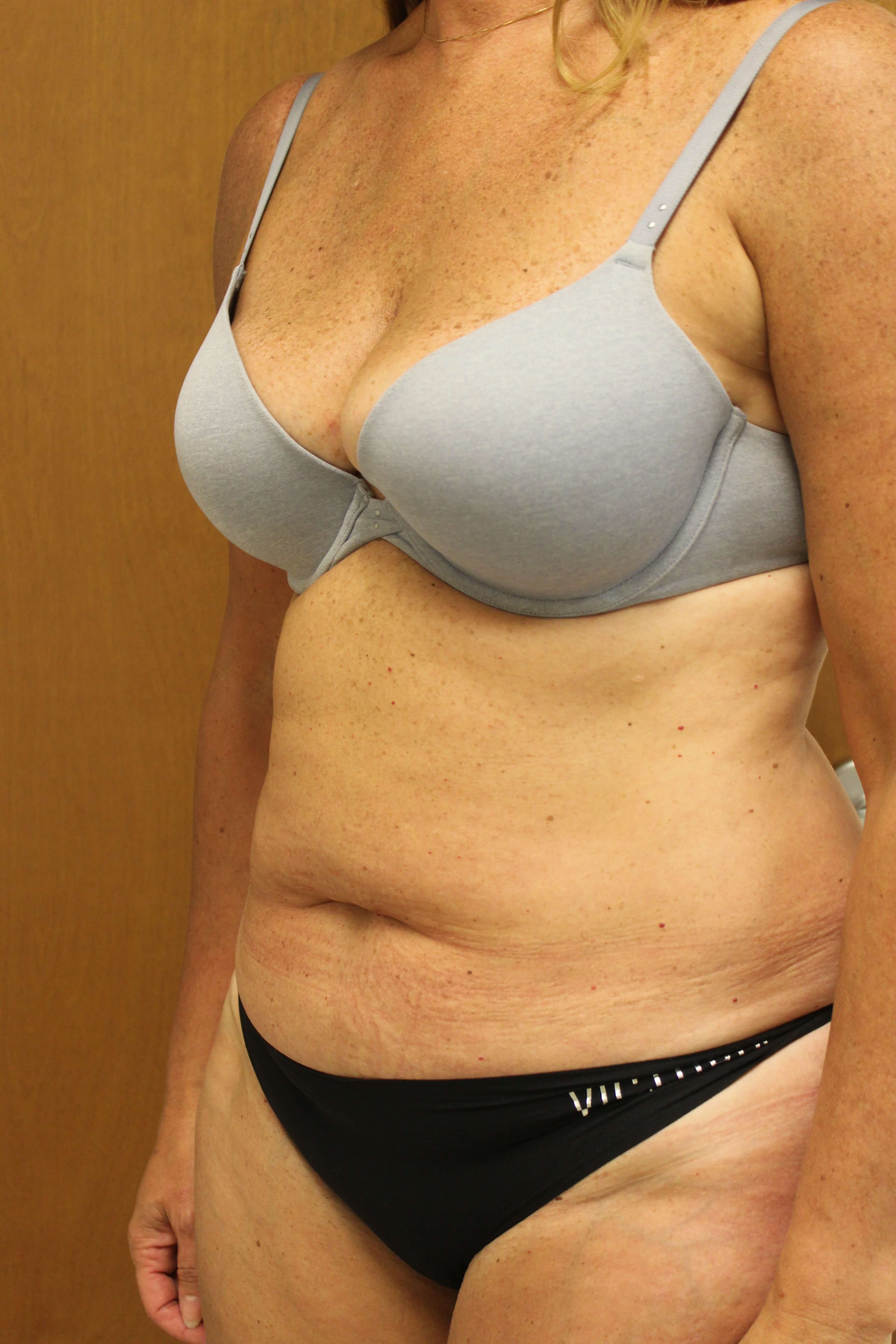 Tummy Tuck Surgery Before