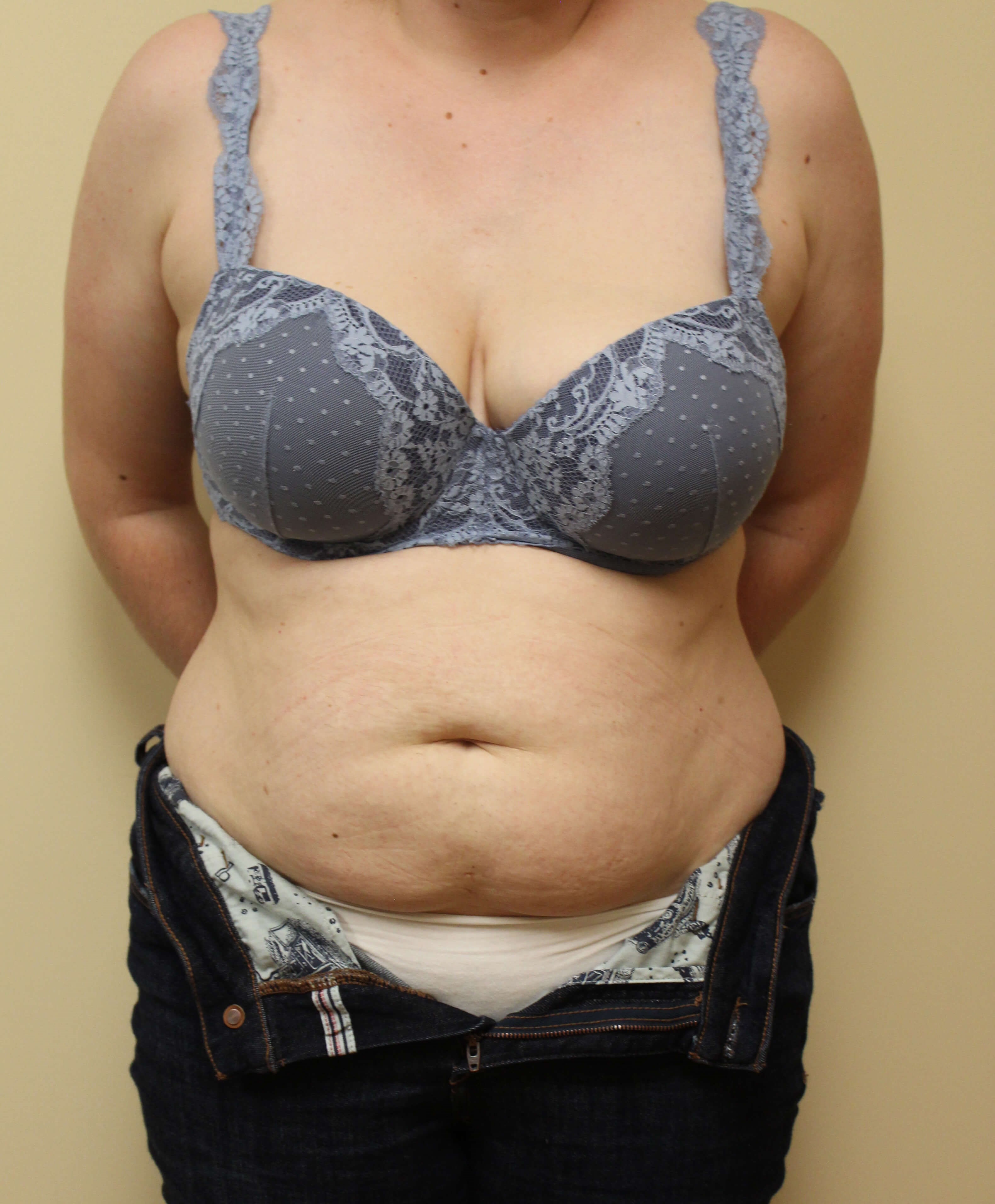 Abdominoplasty Surgery Before
