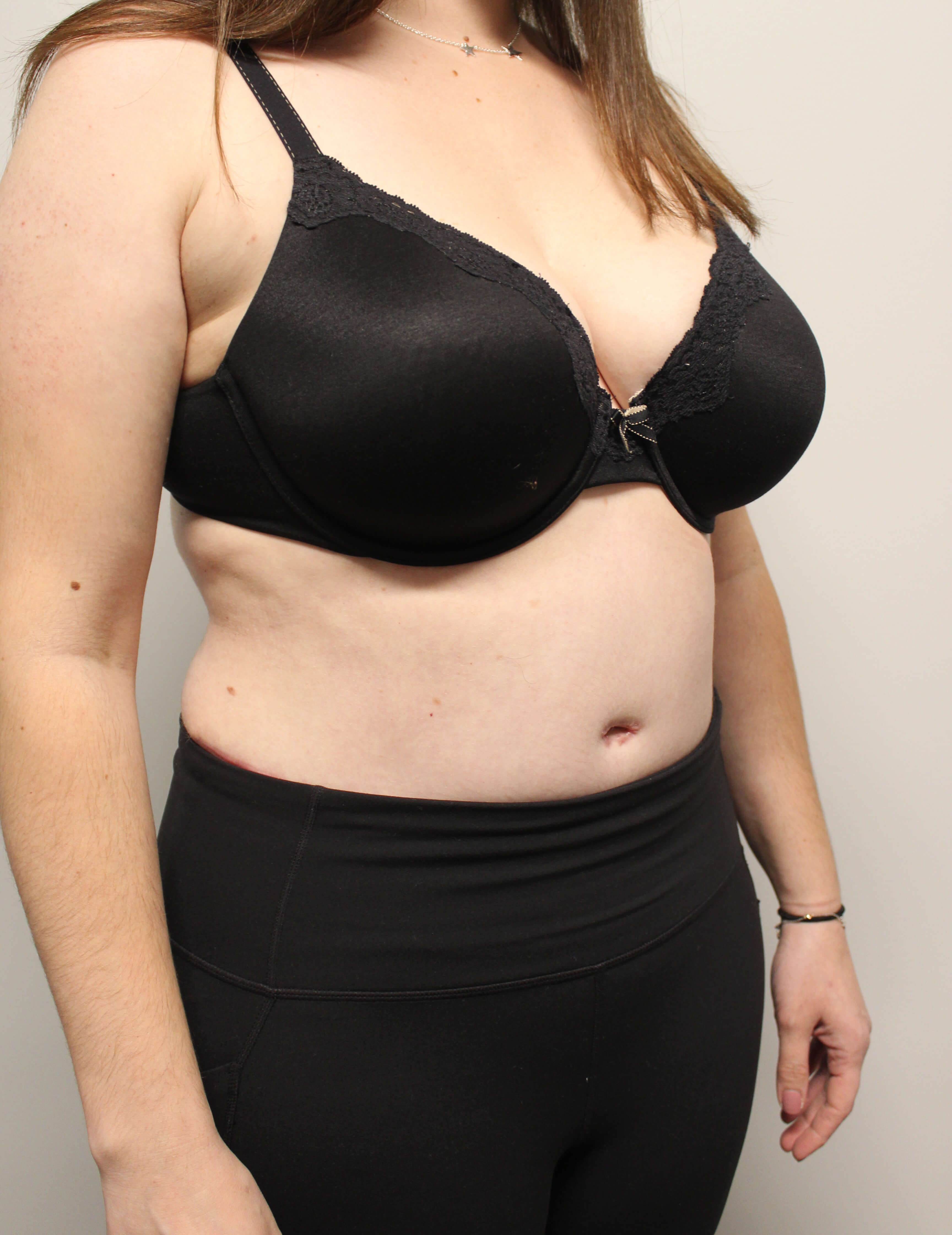 Abdominoplasty Surgery After