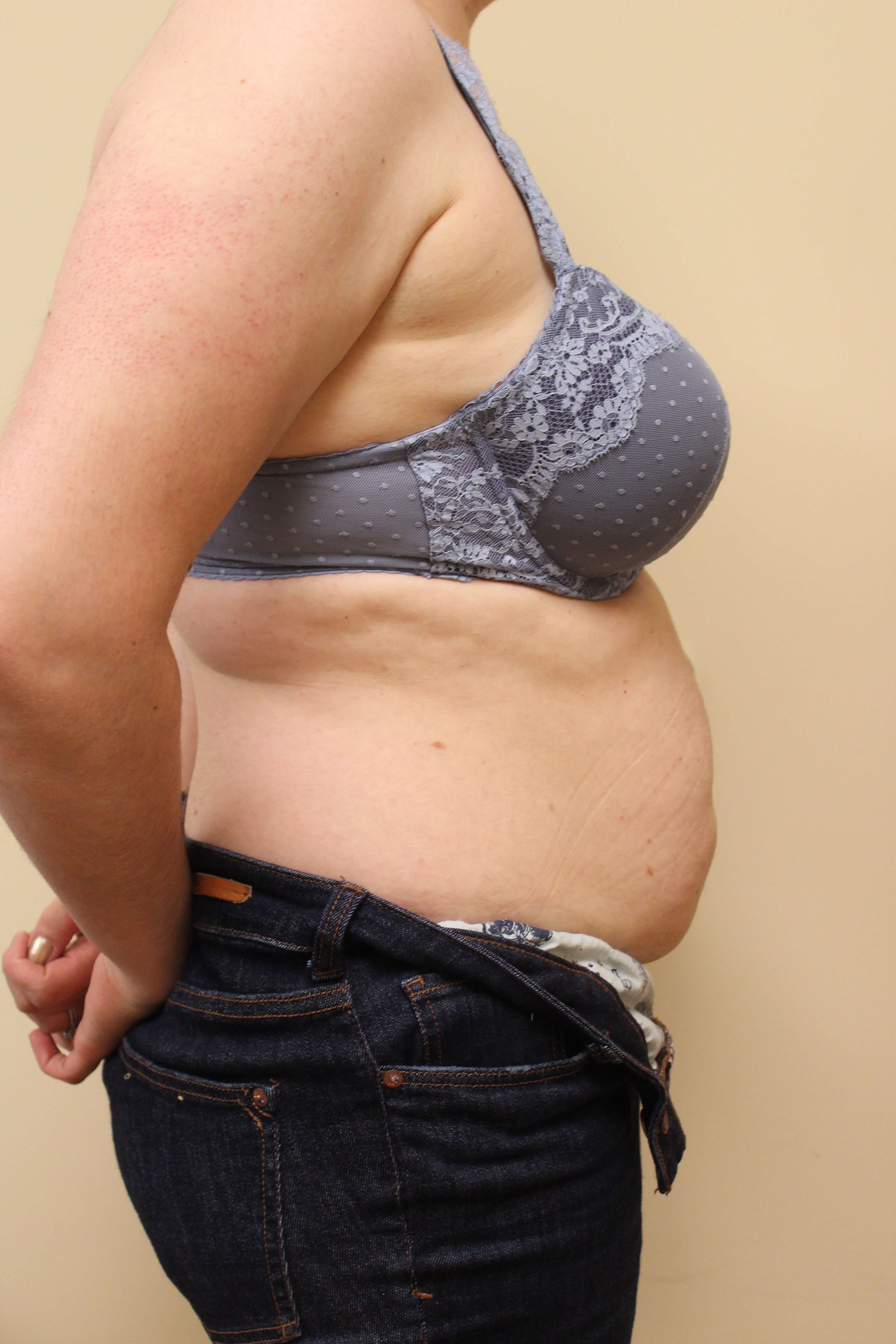 Abdominoplasty Surgery Before