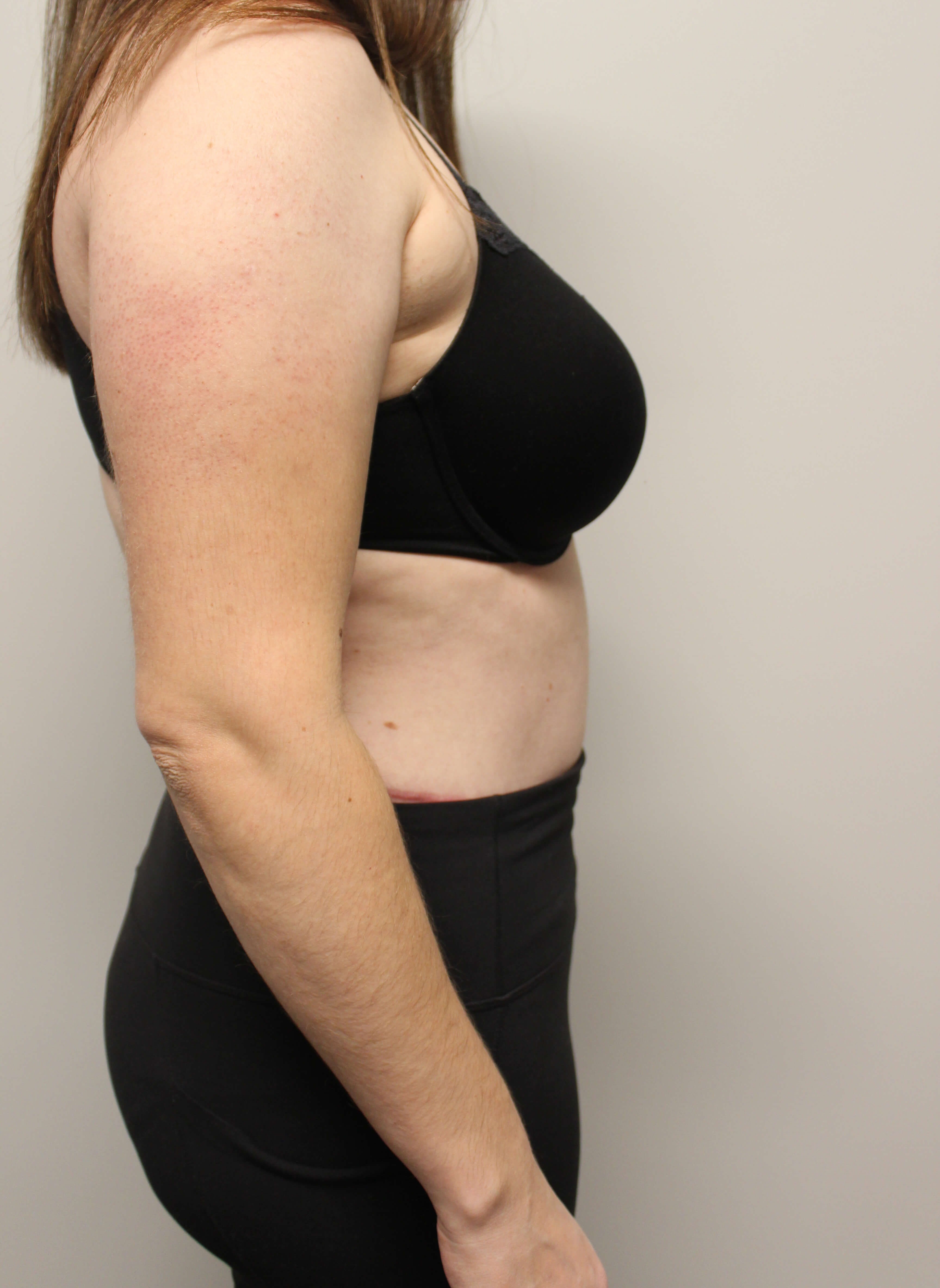 Abdominoplasty Surgery After