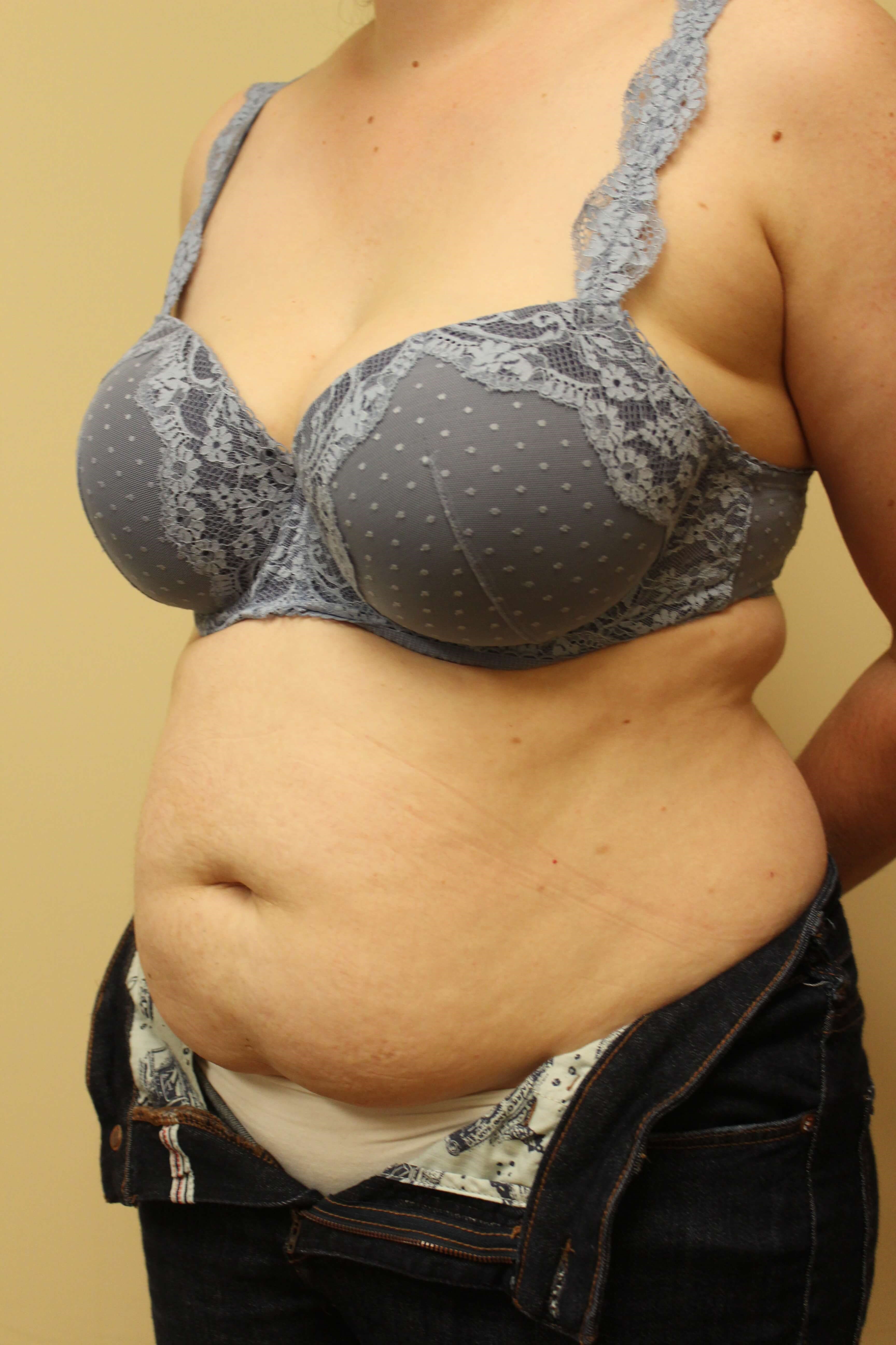 Abdominoplasty Surgery Before