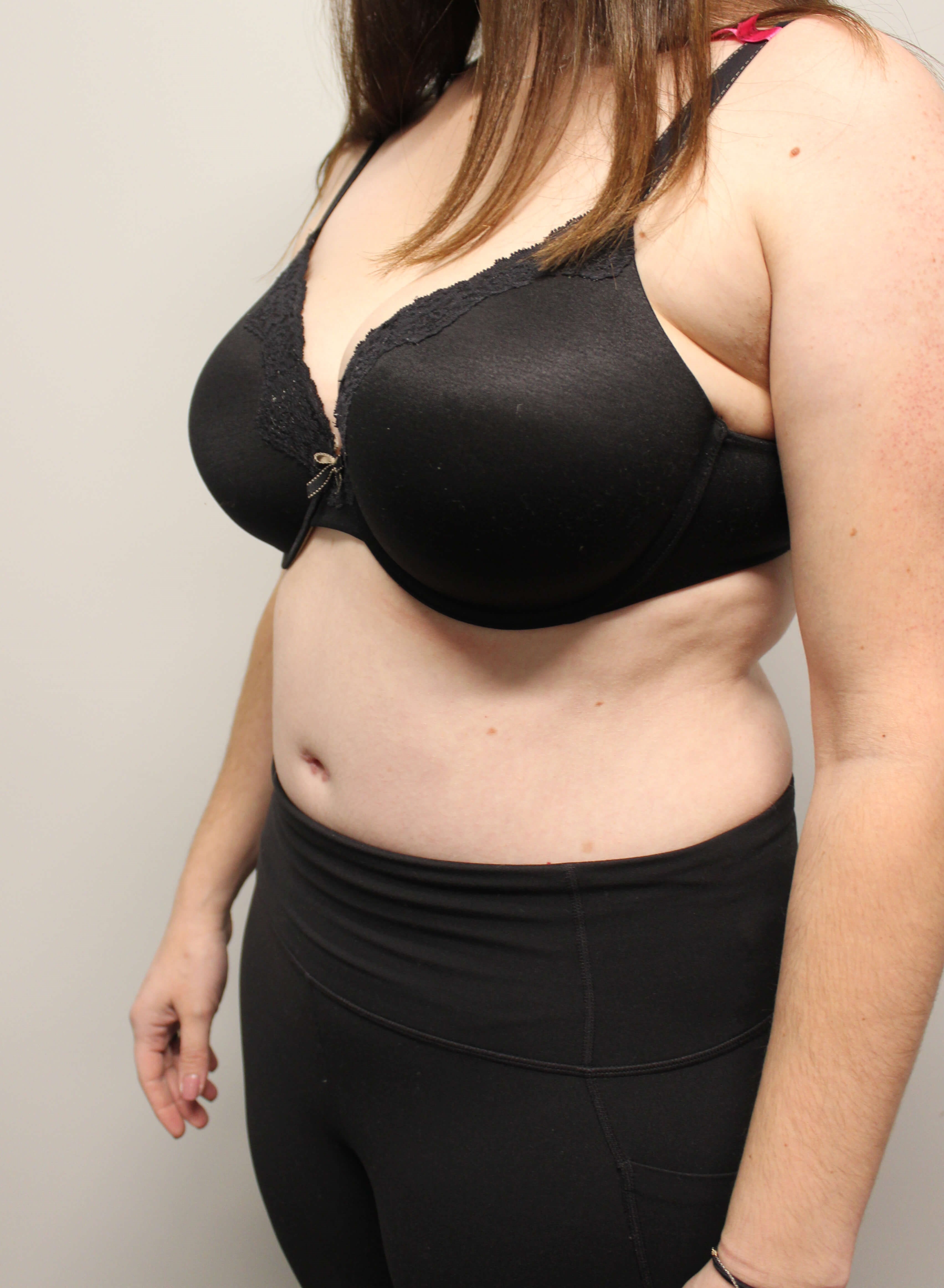 Abdominoplasty Surgery After