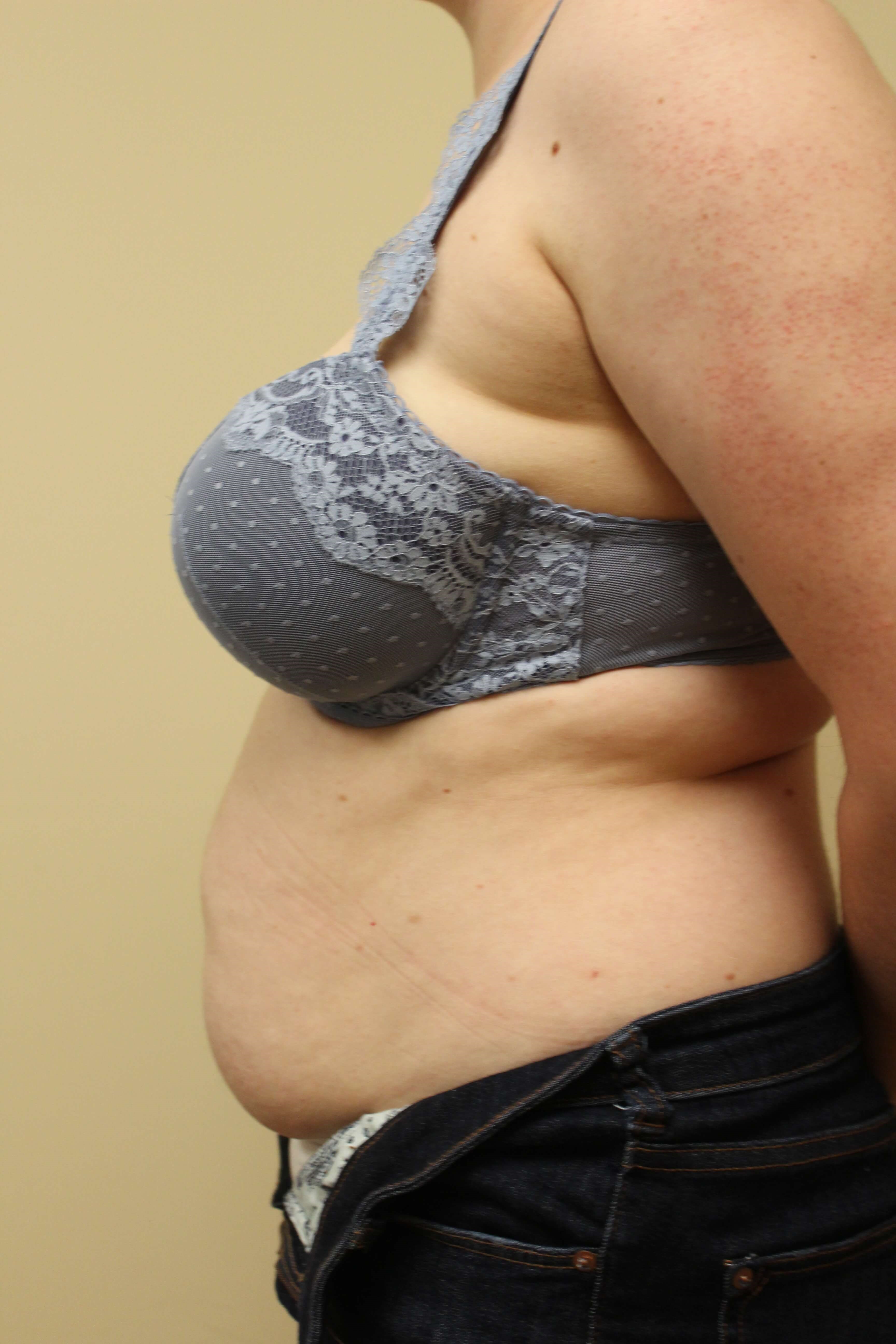 Abdominoplasty Surgery Before