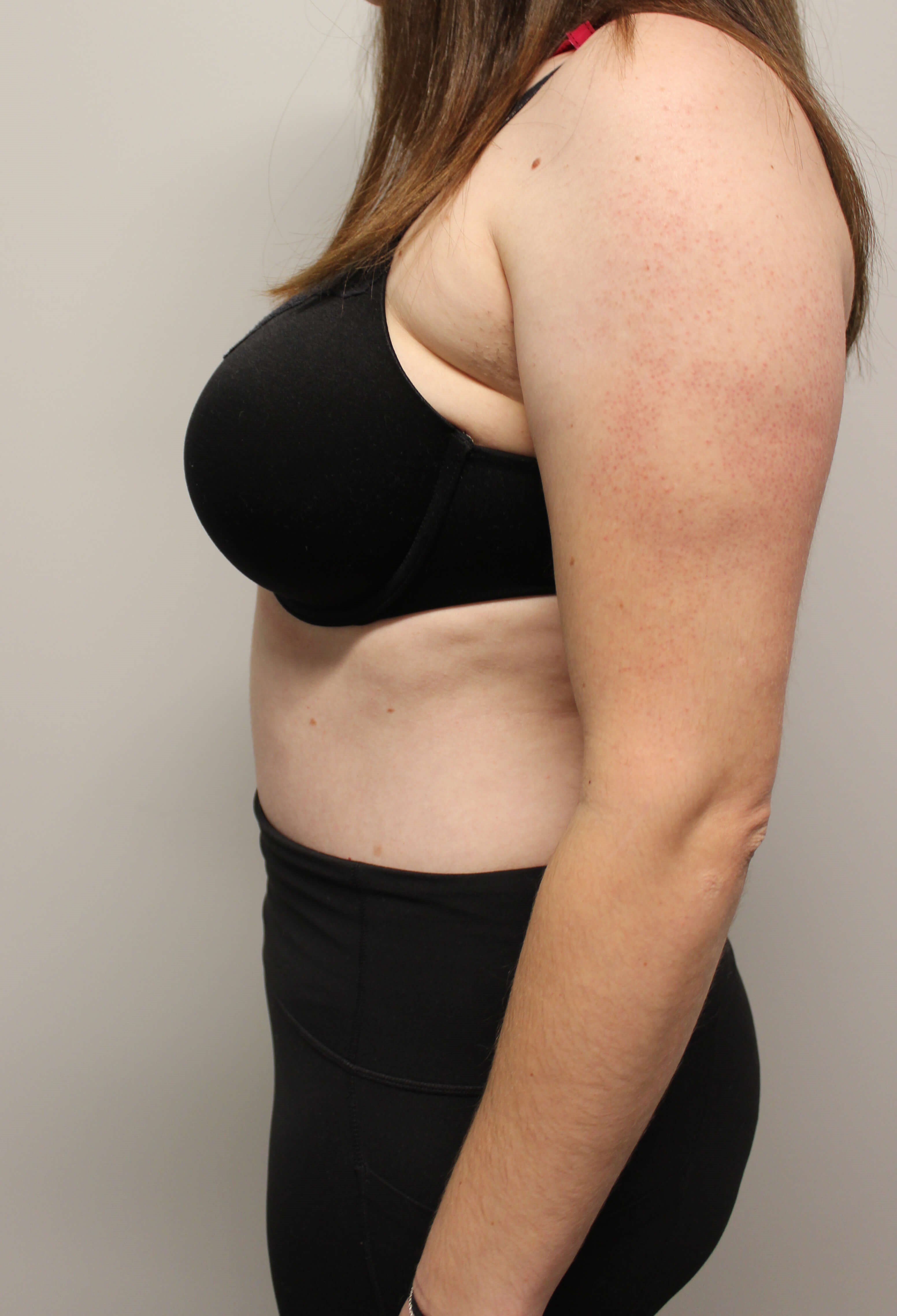 Abdominoplasty Surgery After