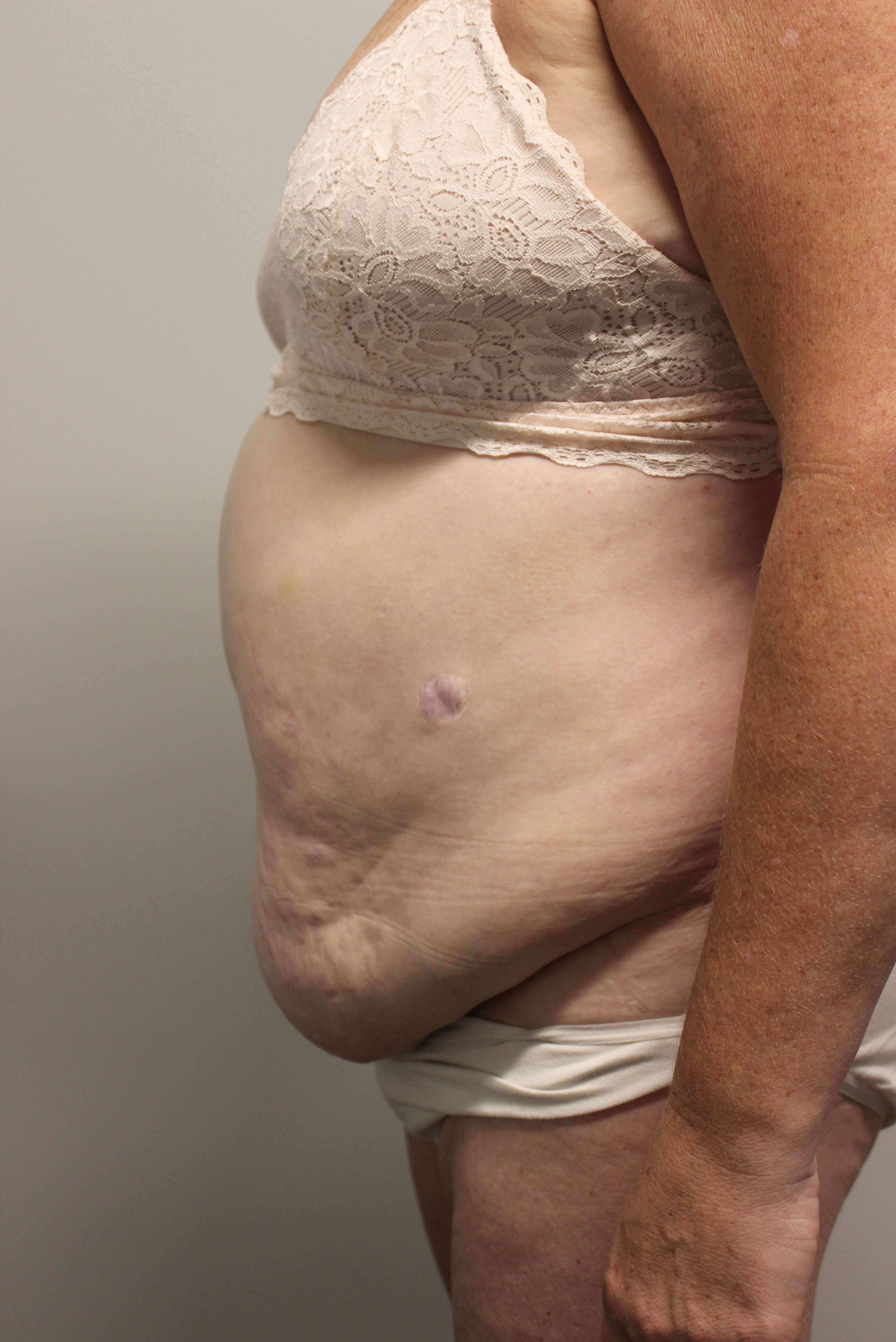 Tummy Tuck after weight loss Before