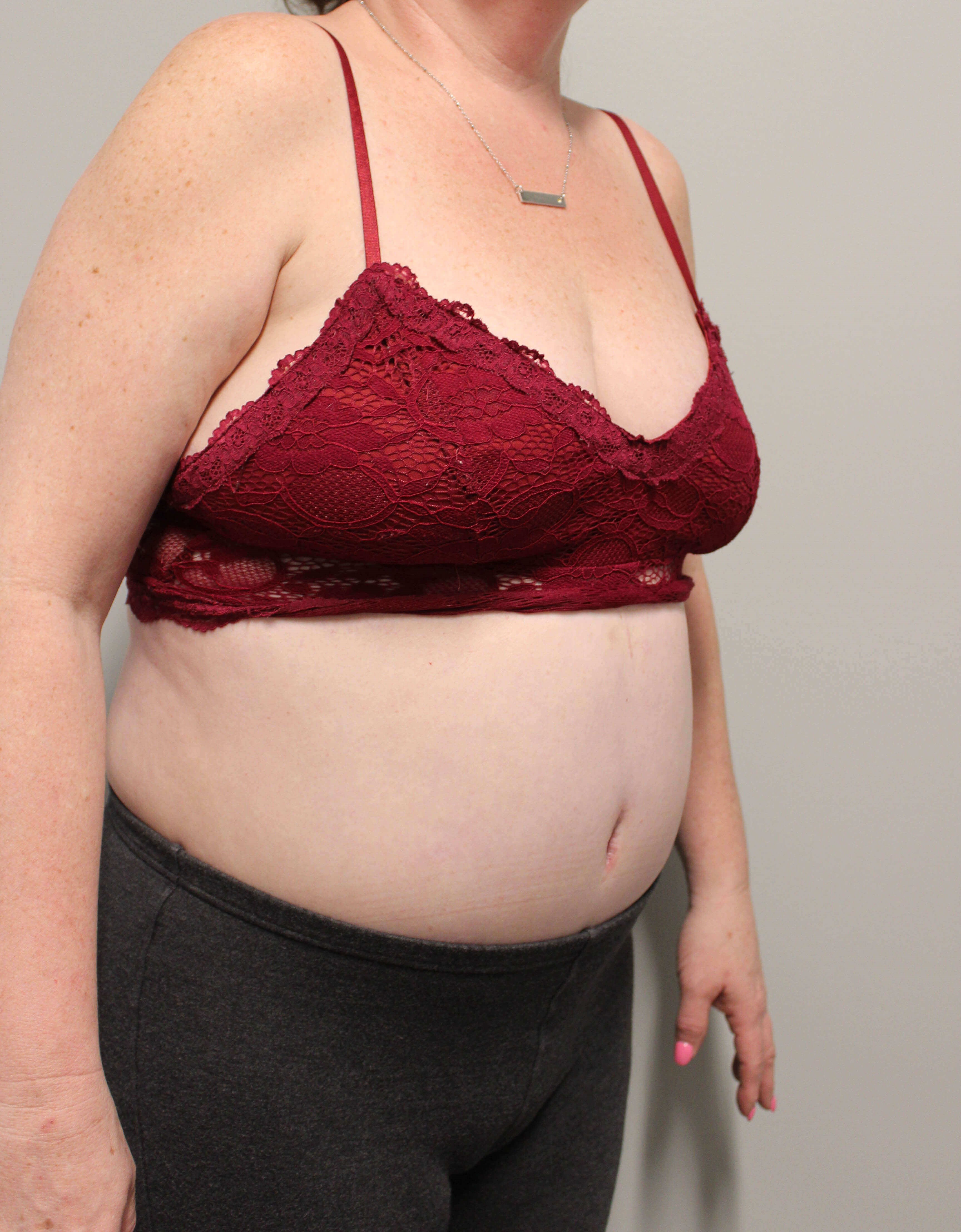 Tummy Tuck after weight loss After