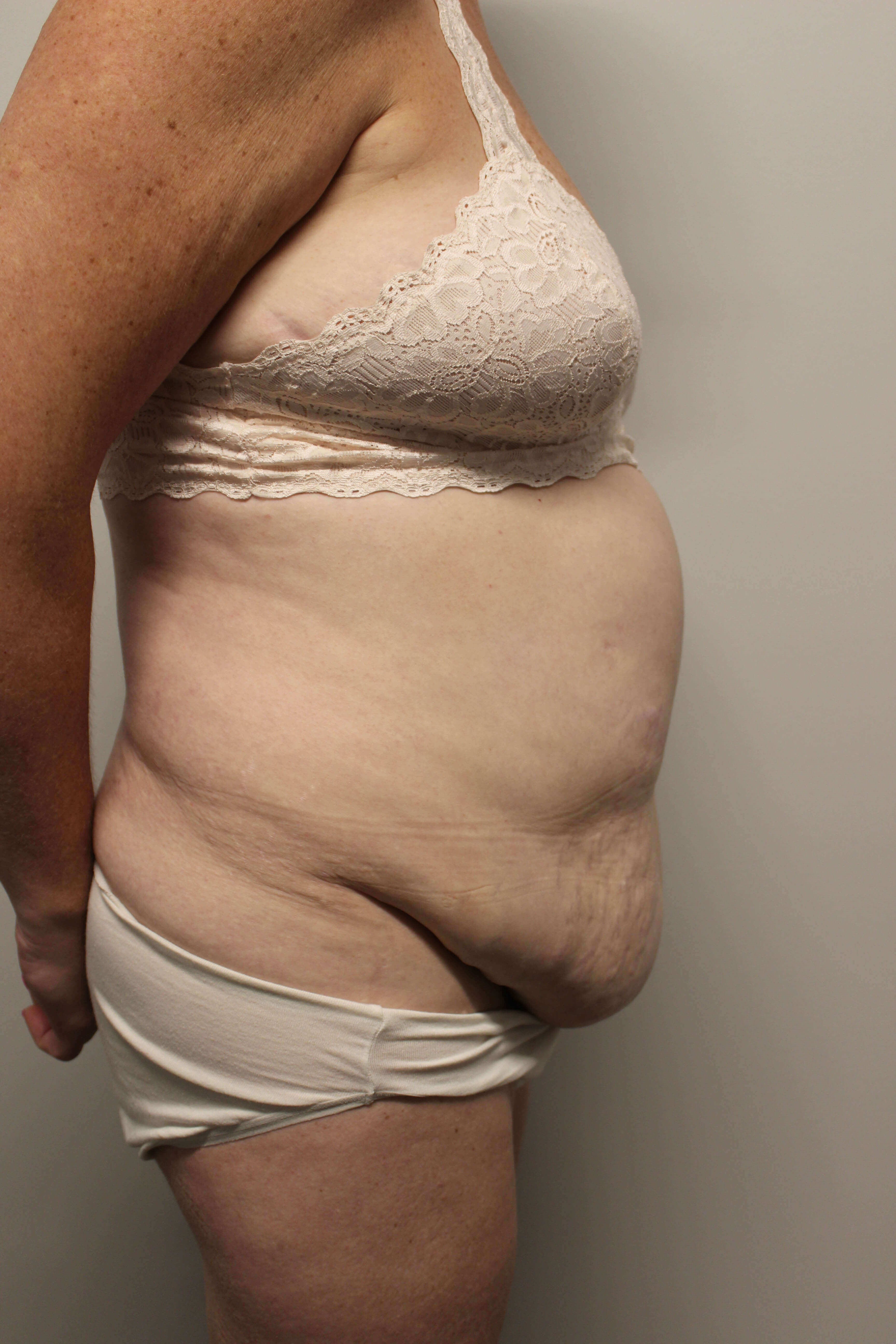 Tummy Tuck after weight loss Before